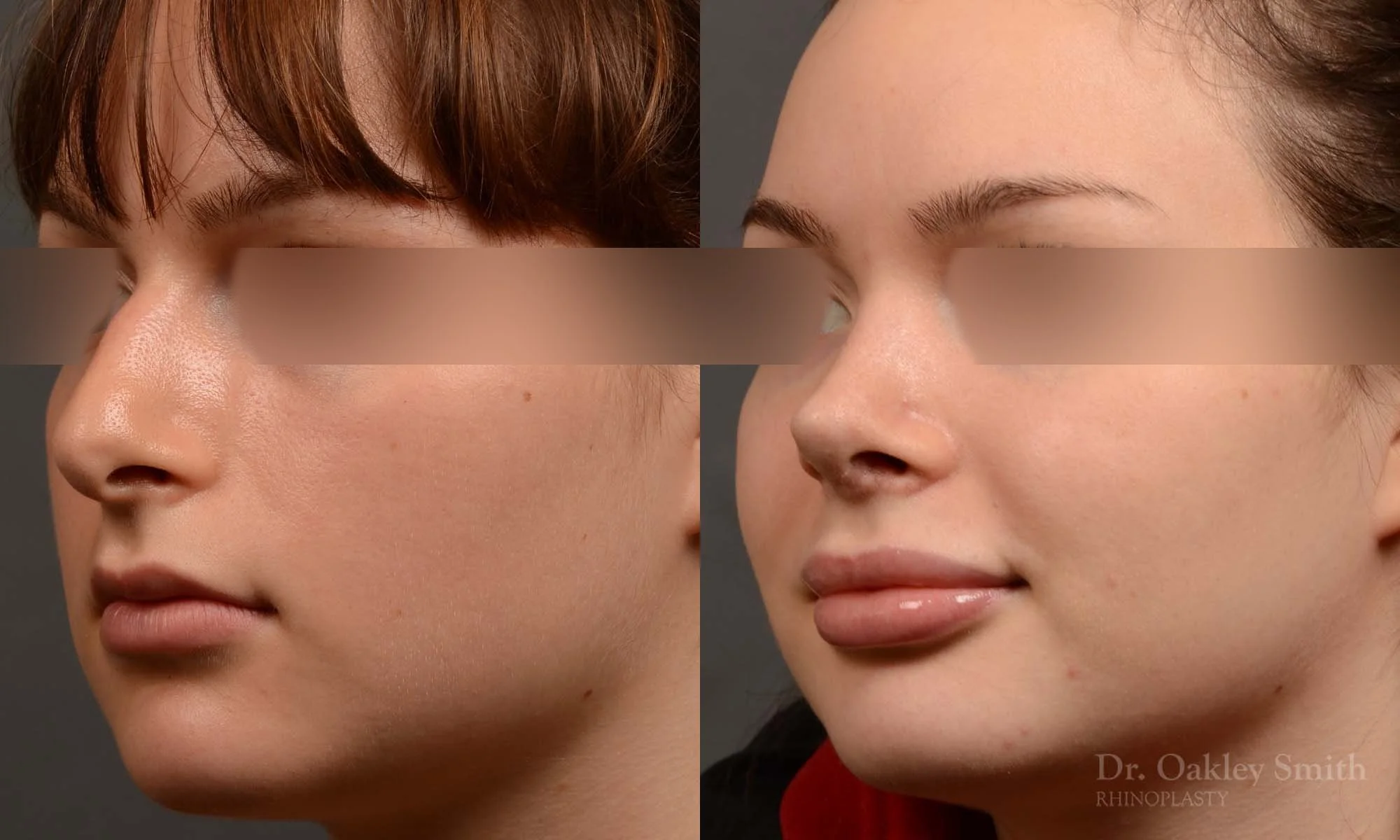 530D-rhinoplasty-dr-oakley-smith-toronto-top-surgeon-nose-job.jpg