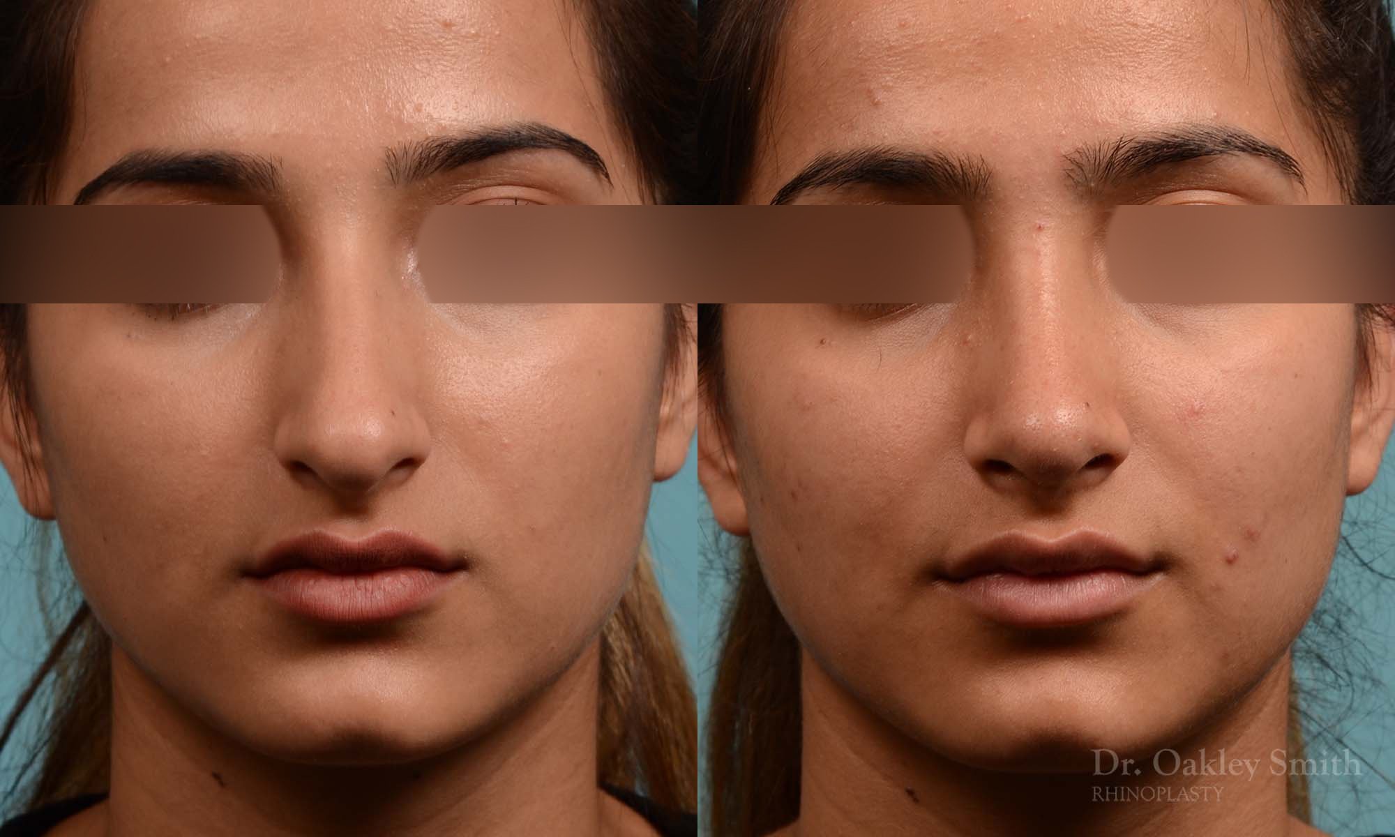 308A-rhinoplasty-dr-oakley-smithm-toronto-nose-job (1).jpg