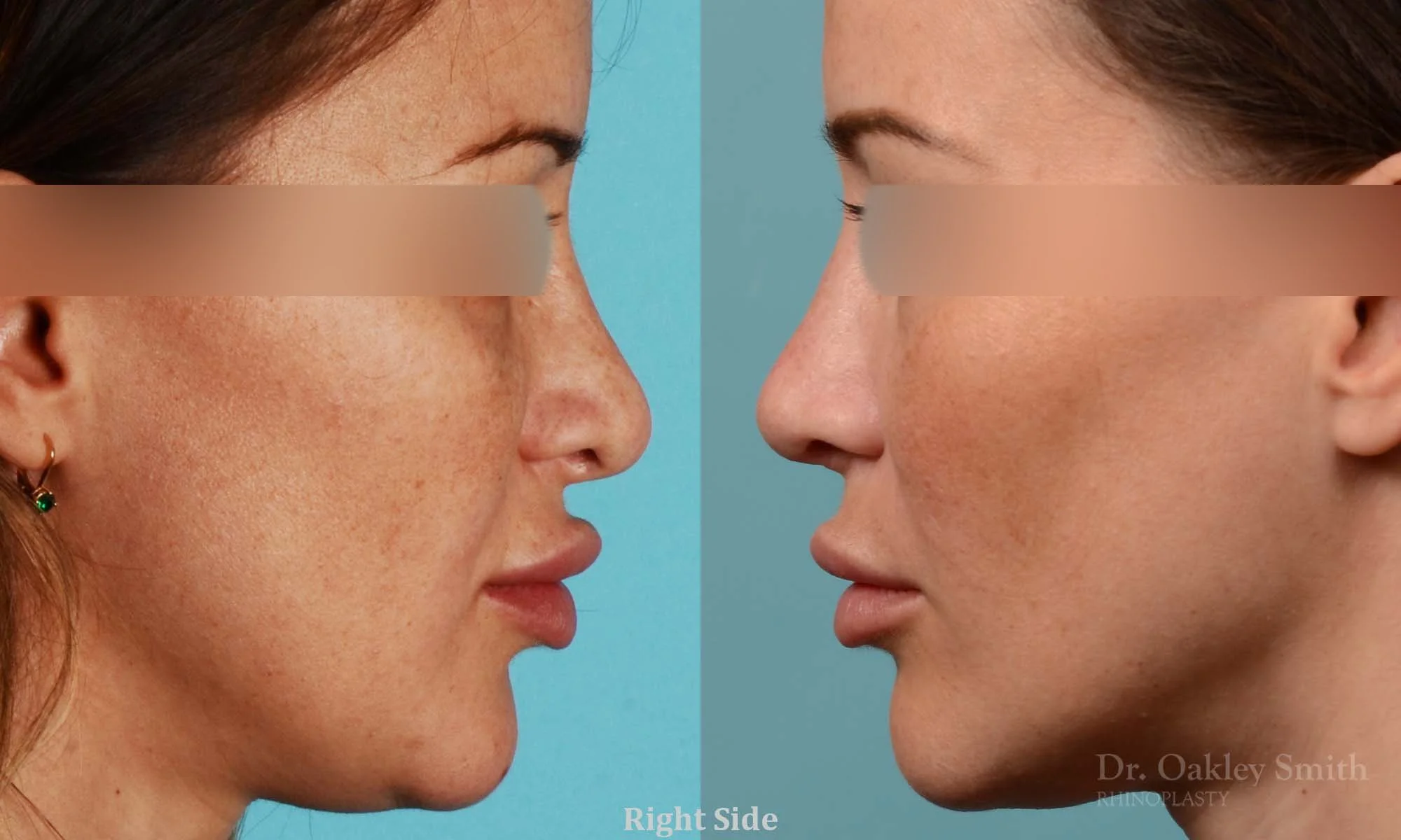 258C-rhinoplasty-dr-oakley-smith-toronto-nose-job.jpg