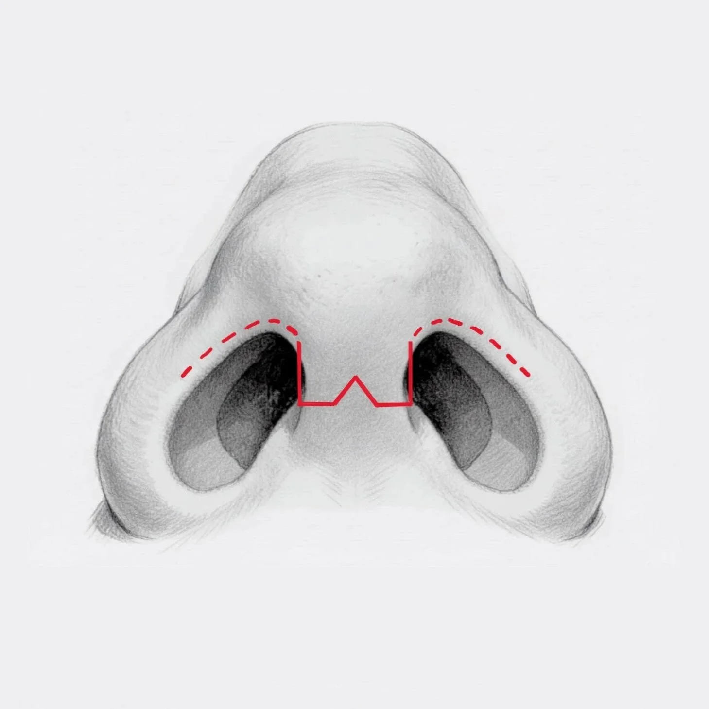 Understanding External Rhinoplasty Scars