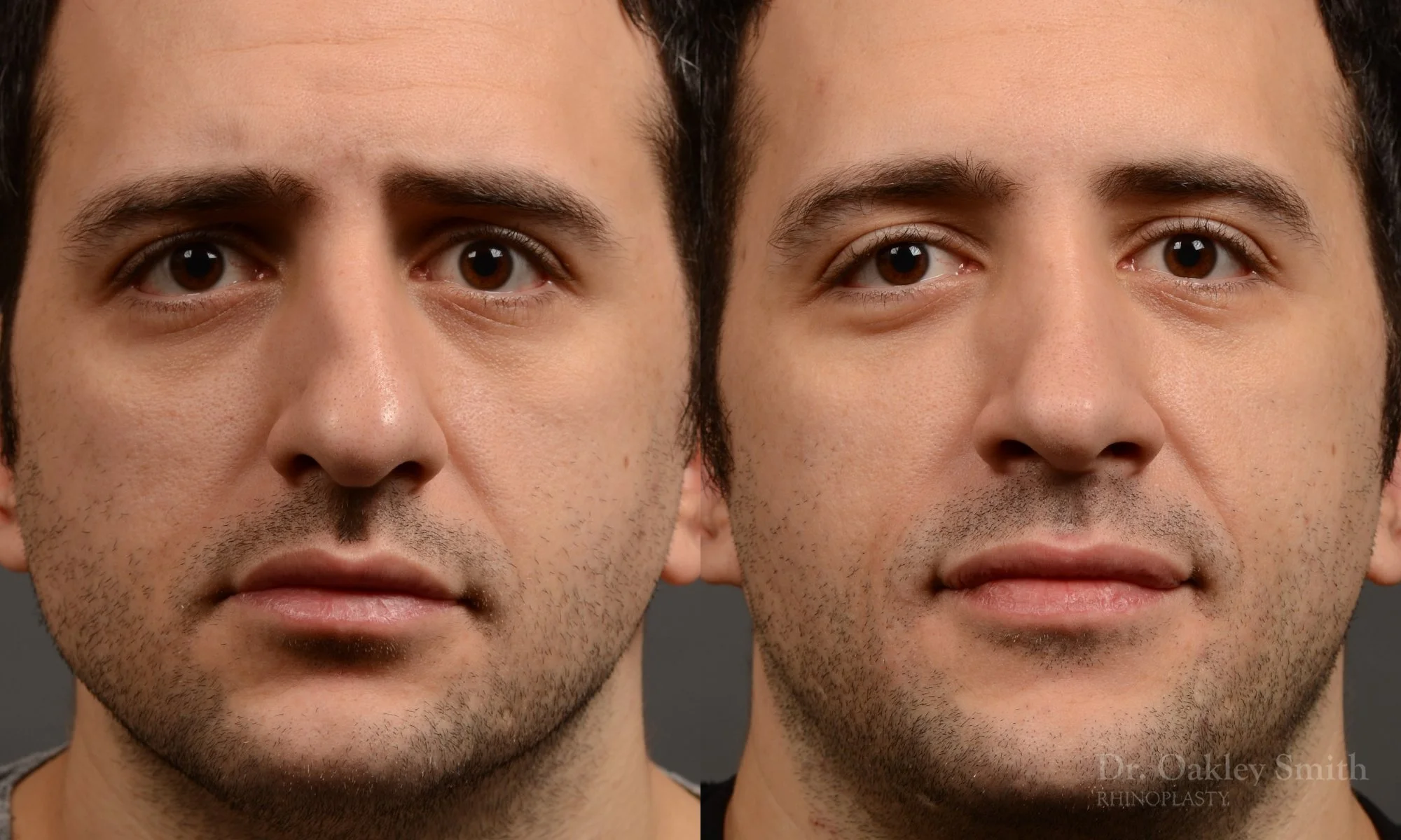 428A-male-rhinoplasty-dr-oakley-smith-toronto-top-surgeon-nose-job.jpg