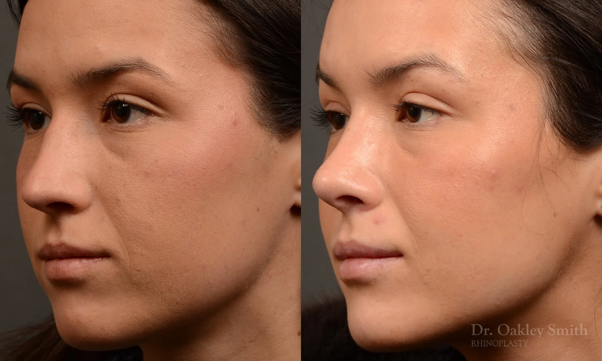 549D-rhinoplasty-nose-job-toronto-nose-surgeon-dr-oakley-smith.jpg