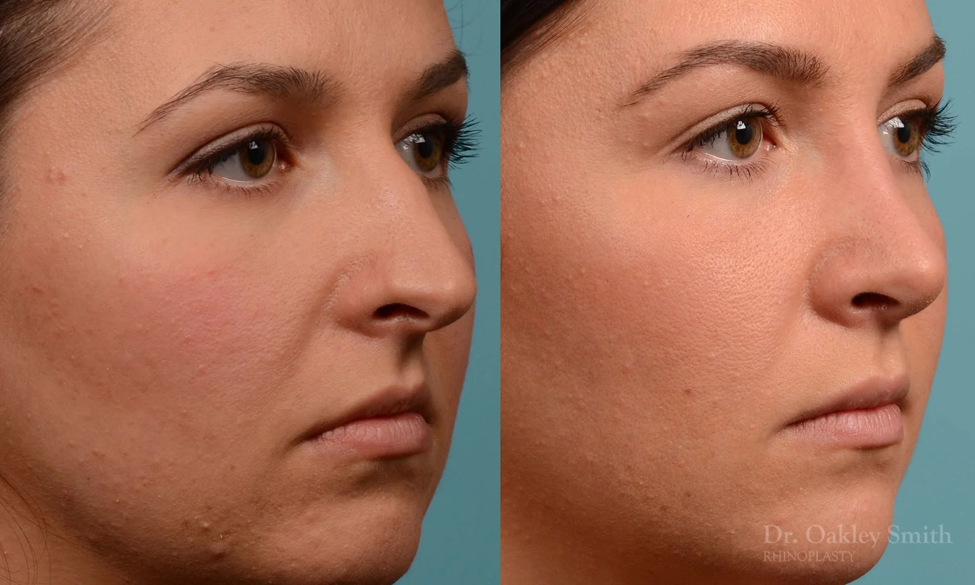 209B-nose-job-curved-nose-straight-profile-deviated-septum-rhinoplasty-septoplasty-dr-oakley-smith-toronto-1.jpg