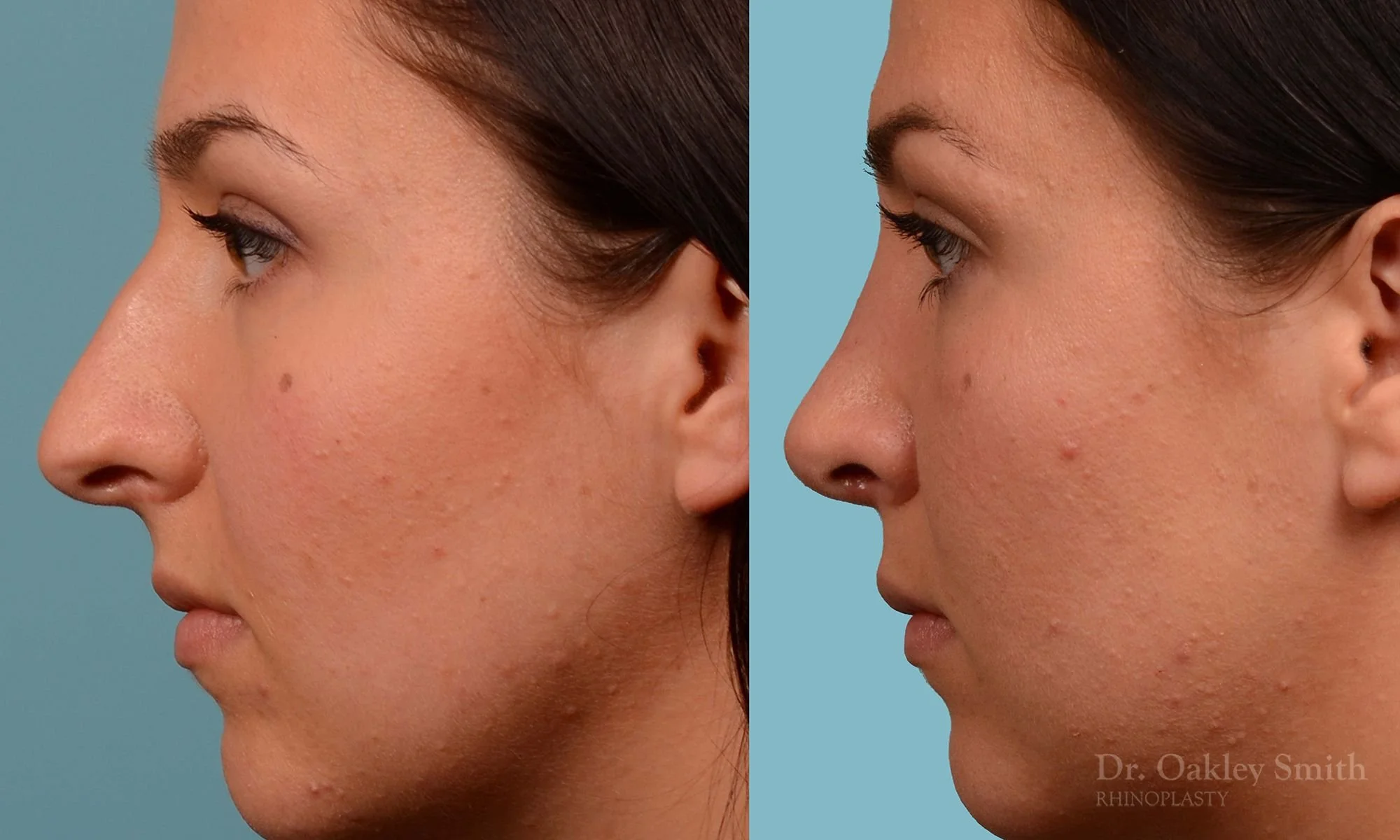 209E-nose-job-curved-nose-straight-profile-deviated-septum-rhinoplasty-septoplasty-dr-oakley-smith-toronto-1.jpg