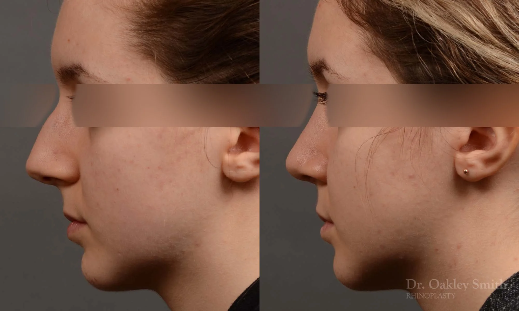 326E-rhinoplasty-dr-oakley-smith-toronto-nose-job.jpg