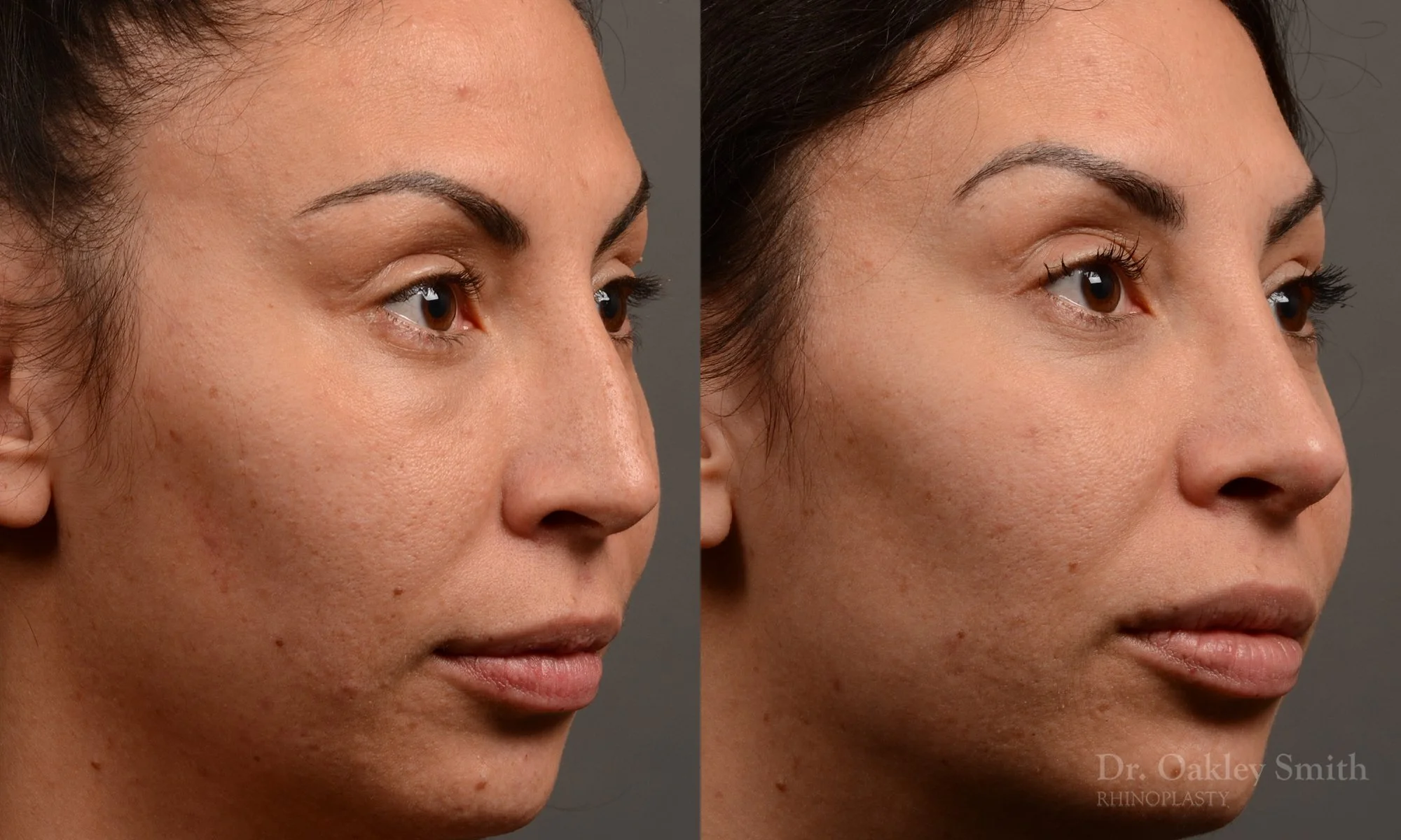 279.1B-rhinoplasty-dr-oakley-smith-toronto-nose-job.jpg