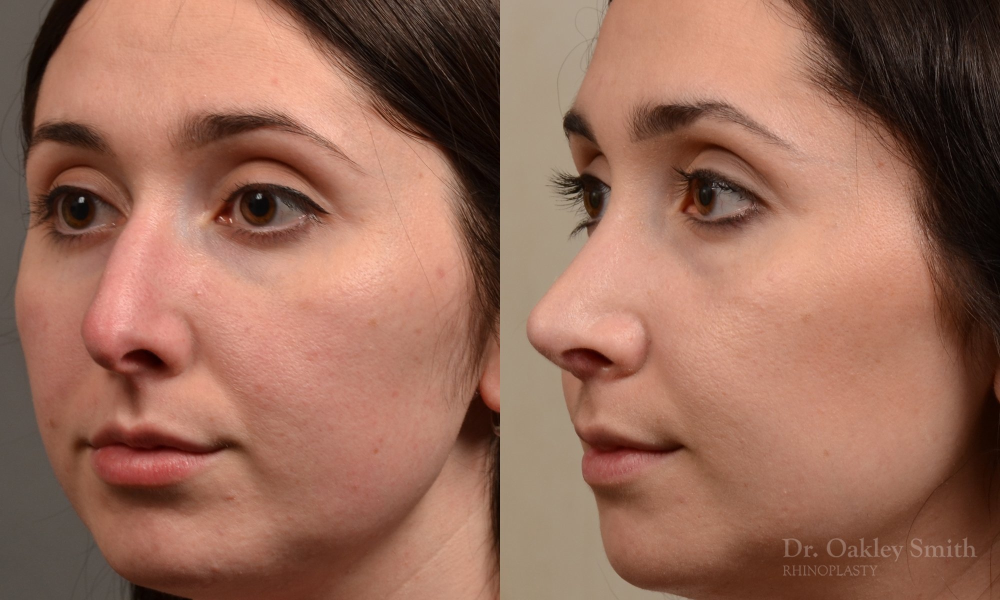 476D-rhinoplasty-dr-oakley-smith-toronto-top-surgeon-nose-job.jpg