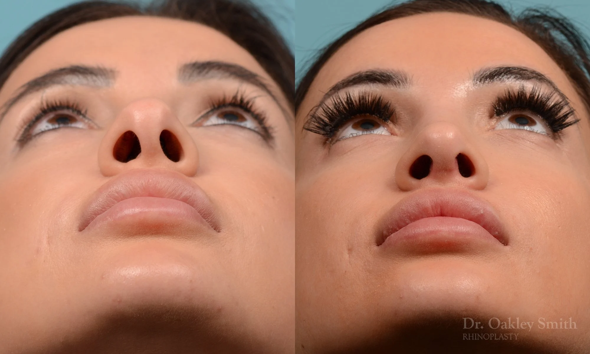 259F-rhinoplasty-dr-oakley-smith-toronto-nose-job.jpg