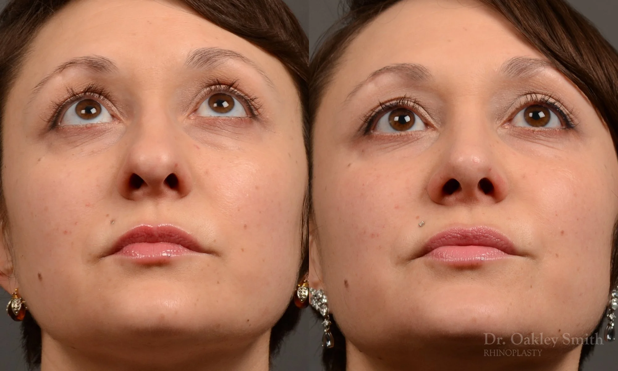 505F-rhinoplasty-dr-oakley-smith-toronto-top-surgeon-nose-job.jpg