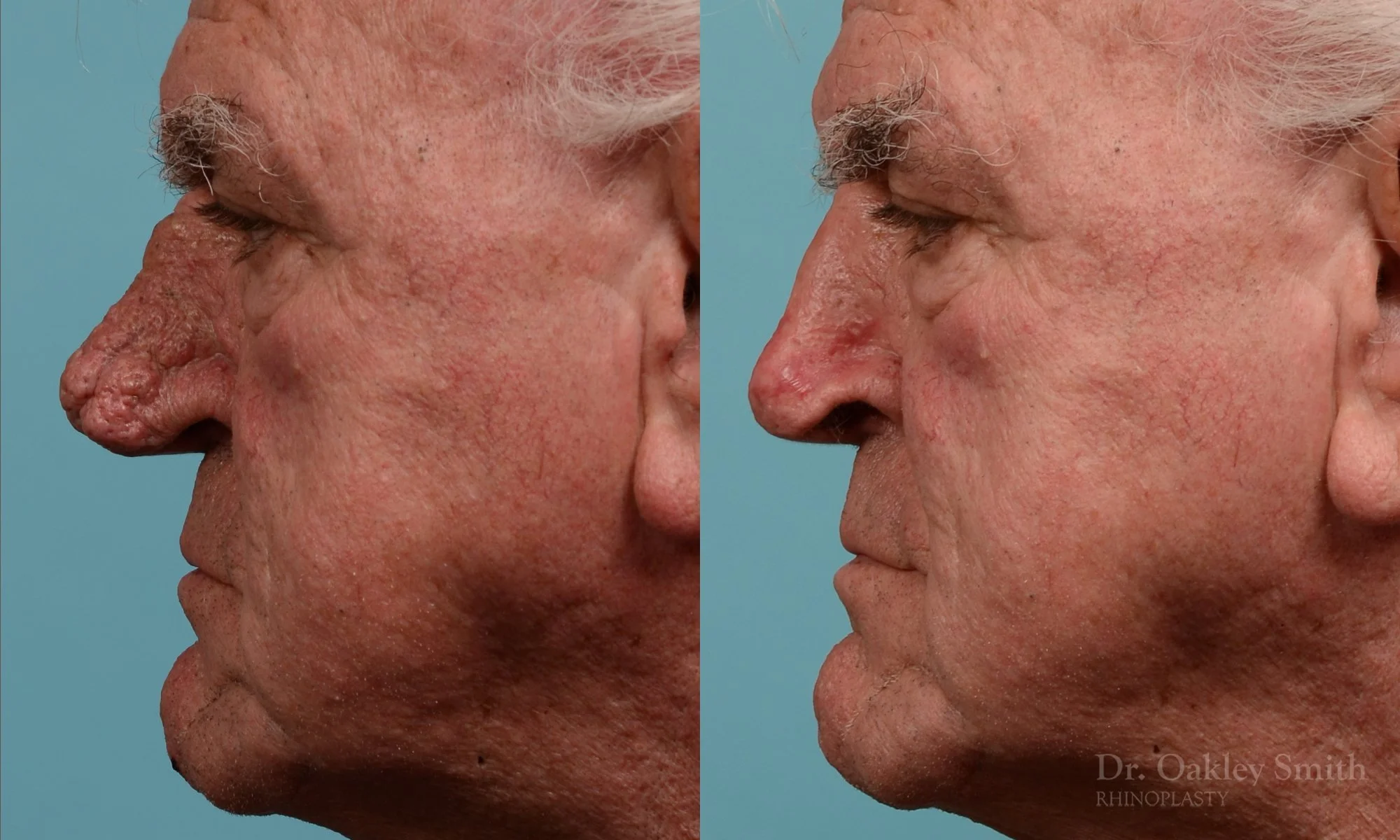245E-rhinophyma-nose-job-rhinoplasty-dr-oakley-smith-toronto-1.jpg