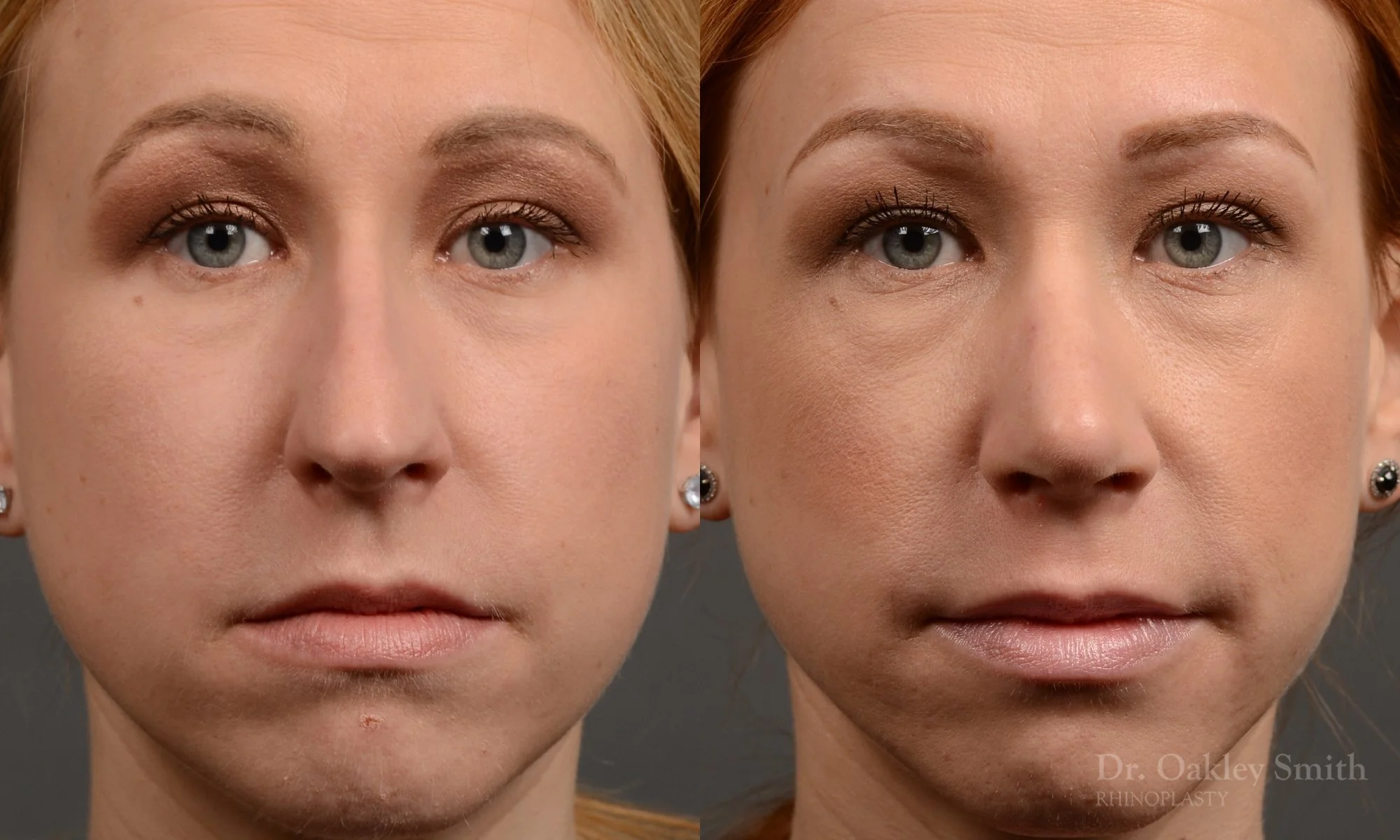 363.2A-rhinoplasty-dr-oakley-smith-toronto-nose-job.jpg