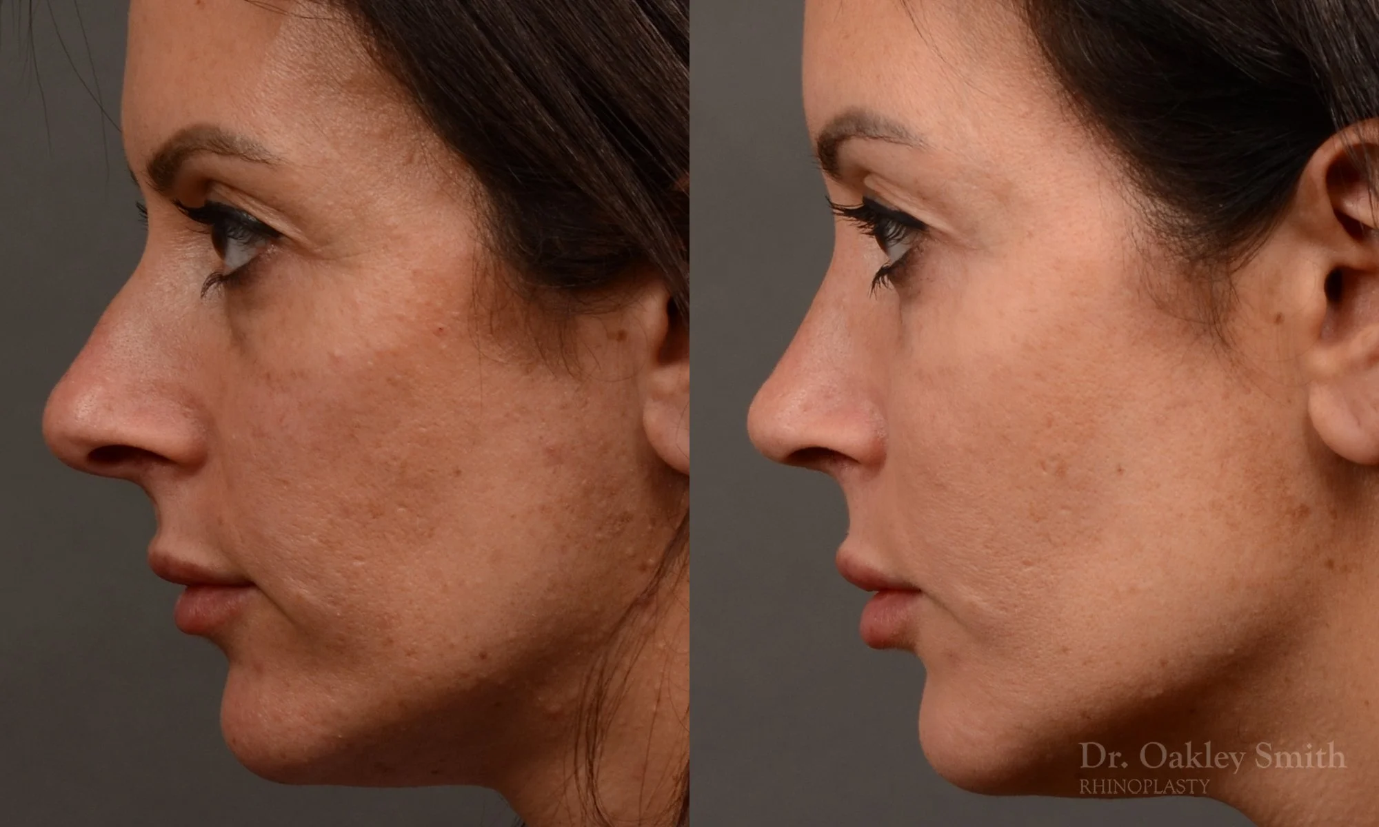 495E-rhinoplasty-dr-oakley-smith-toronto-top-surgeon-nose-job.jpg