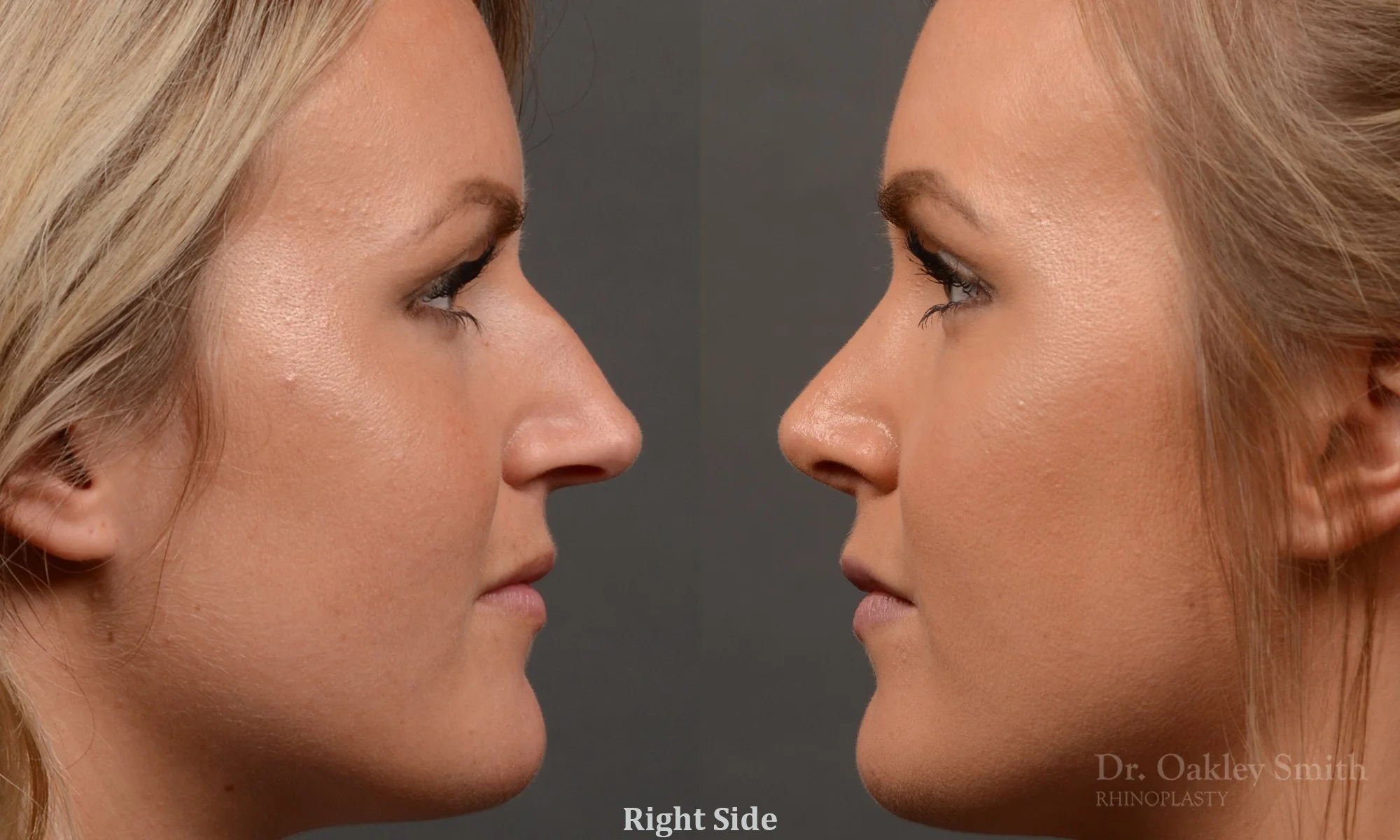 336C-rhinoplasty-dr-oakley-smith-toronto-nose-job.jpg