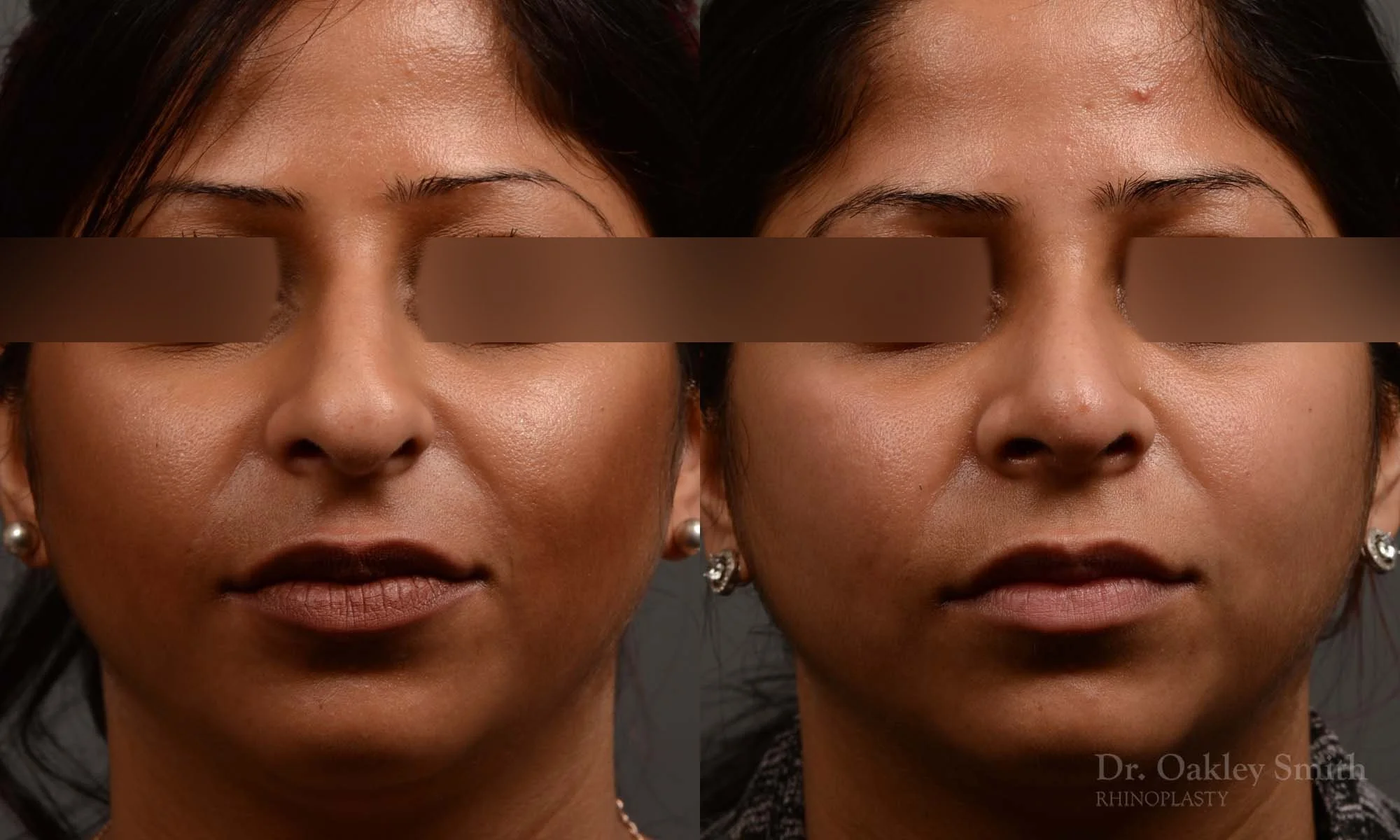 346A-rhinoplasty-dr-oakley-smith-toronto-nose-job.jpg