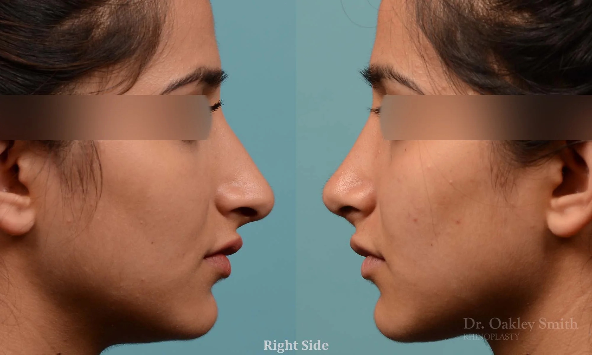 308: Female, Ethnic Rhinoplasty, Thick Skin, Dorsal Hump, Tip Droopy