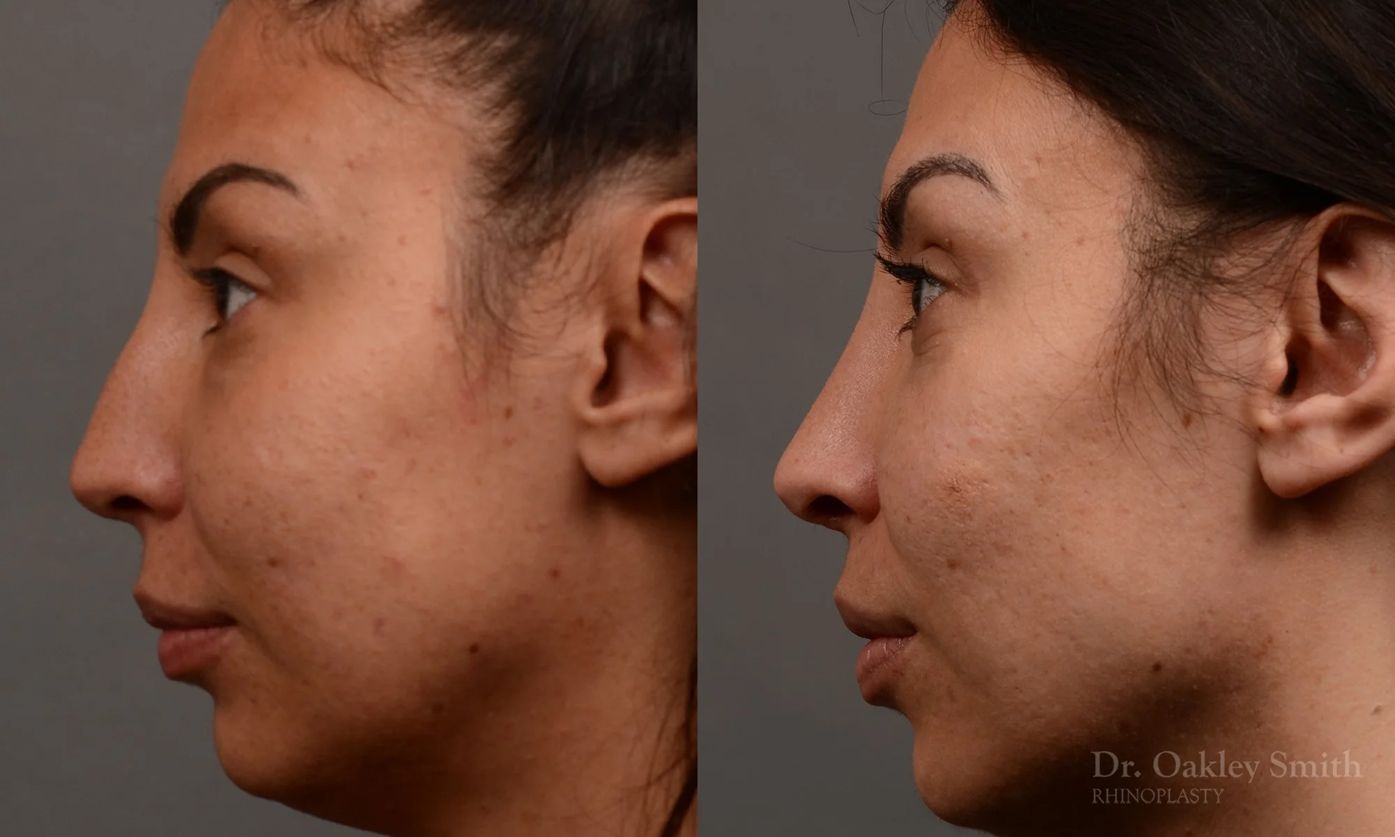279.1E-rhinoplasty-dr-oakley-smith-toronto-nose-job.jpg