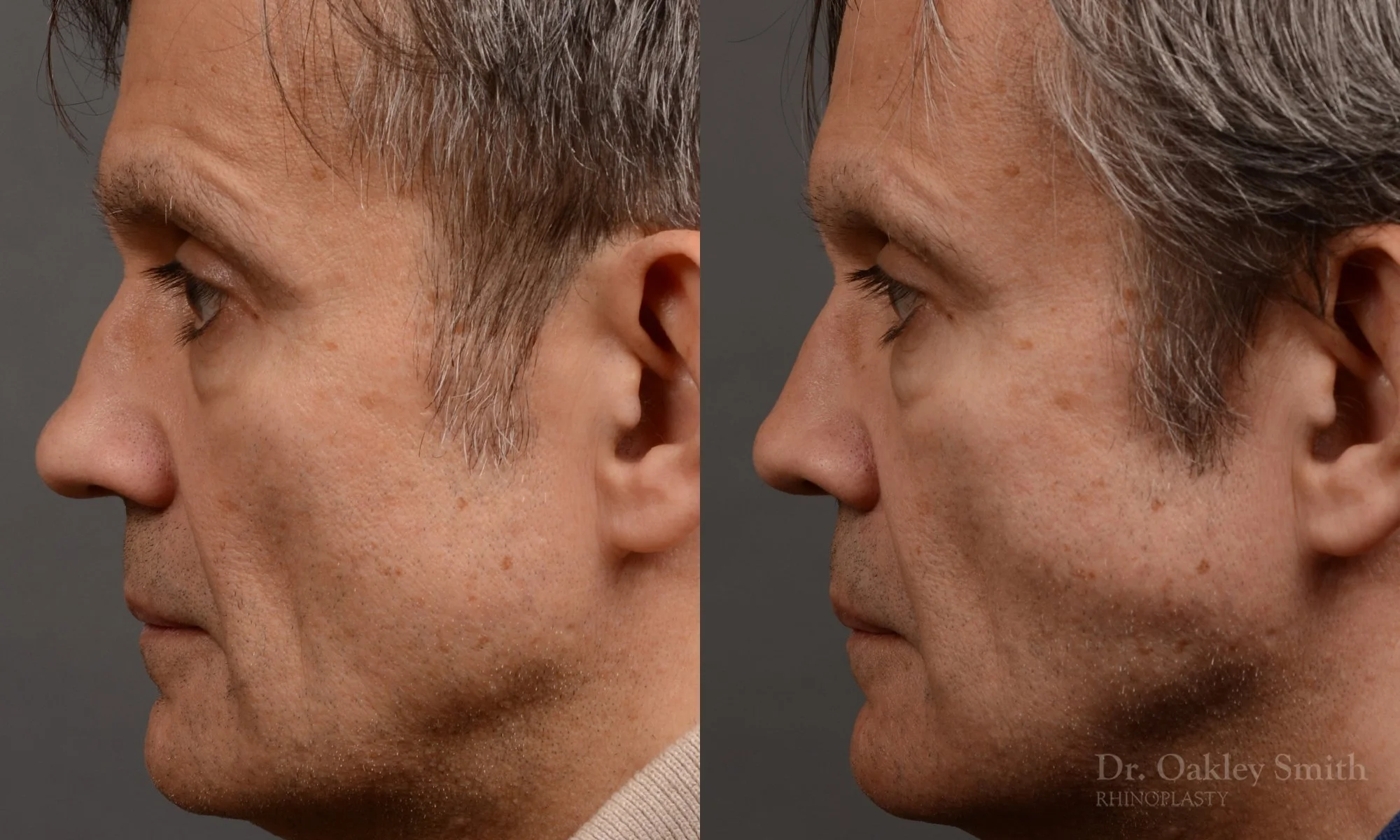 306.1E-rhinoplasty-dr-oakley-smith-toronto-nose-job.jpg