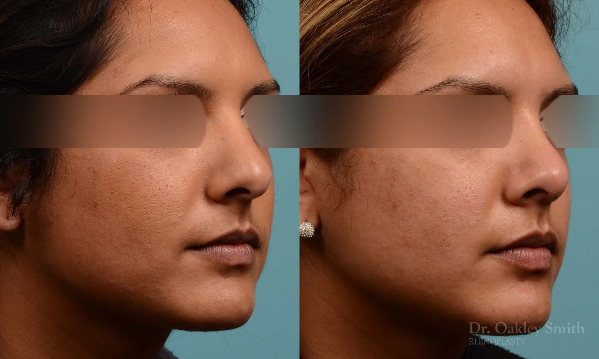 271B-rhinoplasty-dr-oakley-smith-toronto-nose-job.jpg