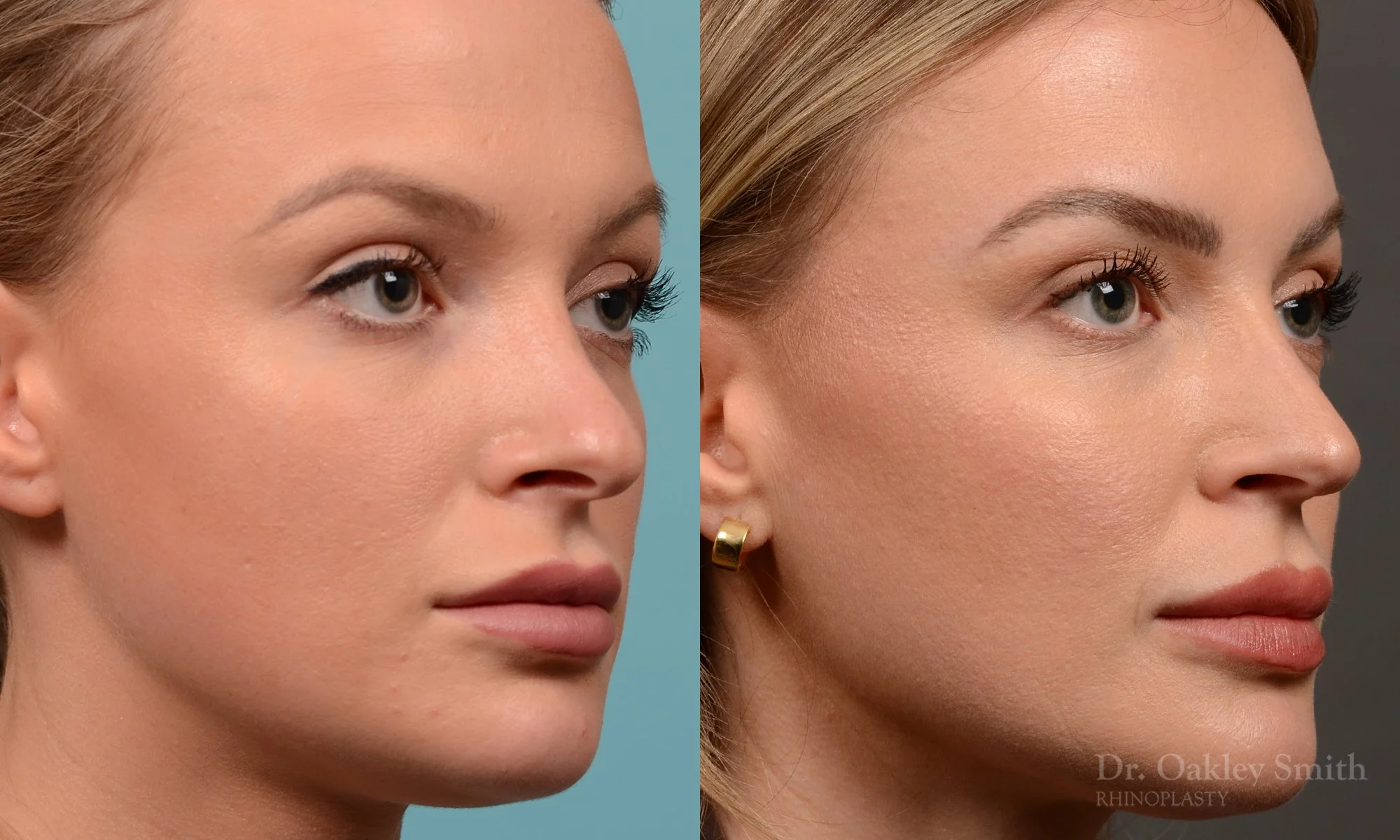 538B-rhinoplasty-dr-oakley-smith-toronto-nose-job.jpg