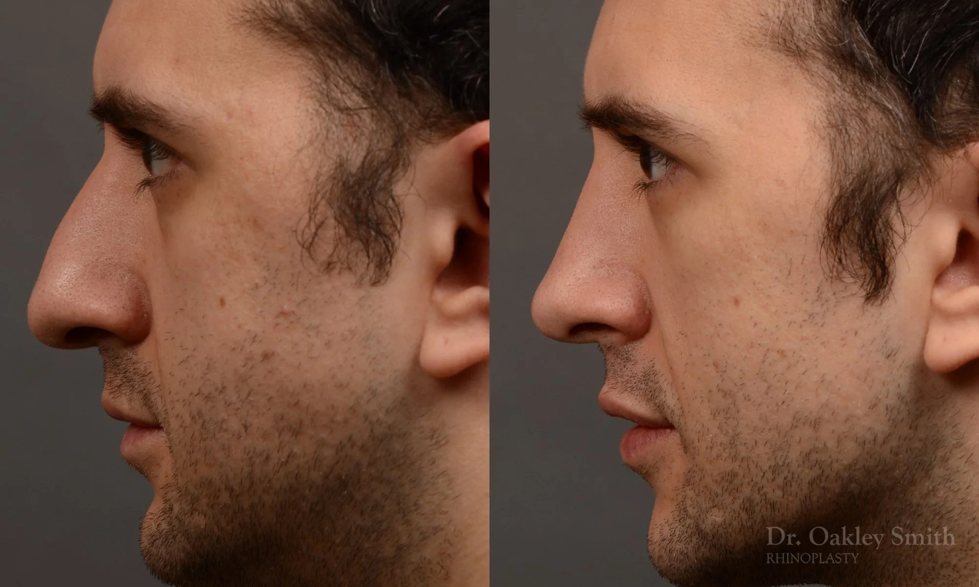 428E-male-rhinoplasty-dr-oakley-smith-toronto-top-surgeon-nose-job.jpg