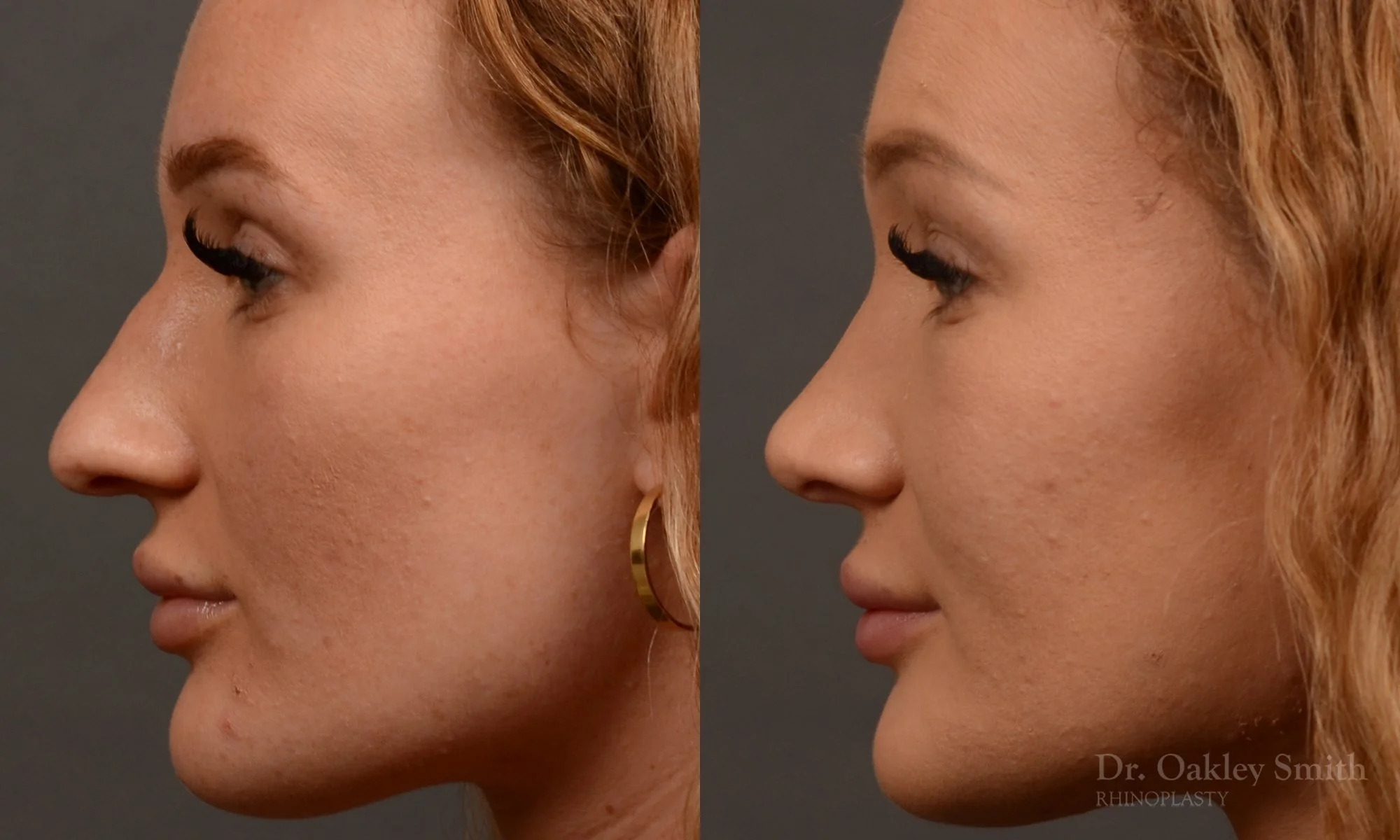 491E-rhinoplasty-dr-oakley-smith-toronto-top-surgeon-nose-job.jpg
