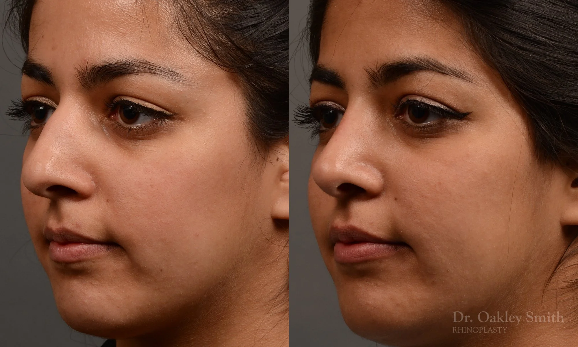 296.5D-rhinoplastydr-oakley-smith-toronto-nose-job.jpg