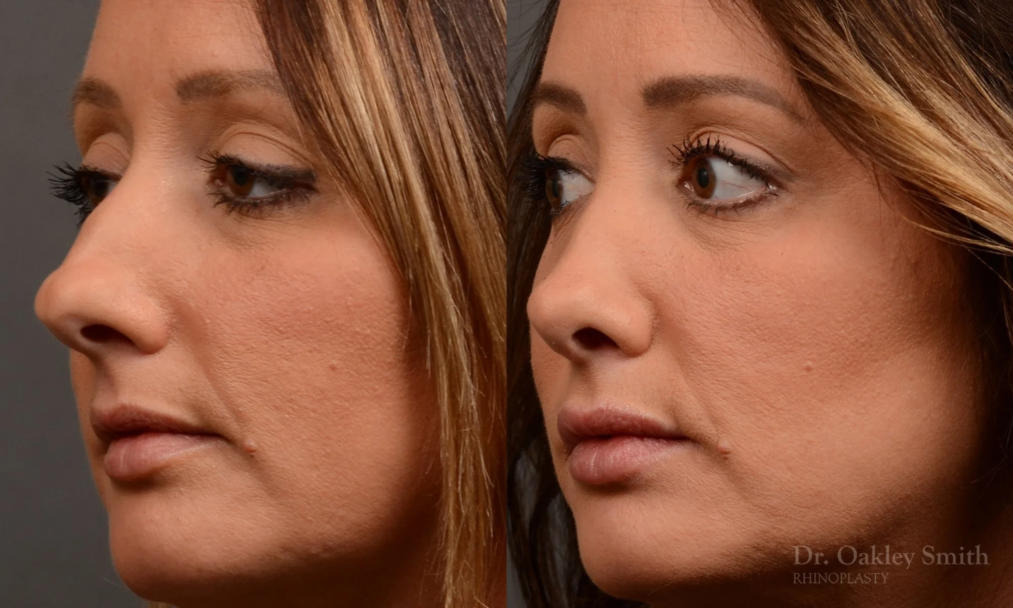 499D-rhinoplasty-dr-oakley-smith-toronto-top-surgeon-nose-job.jpg