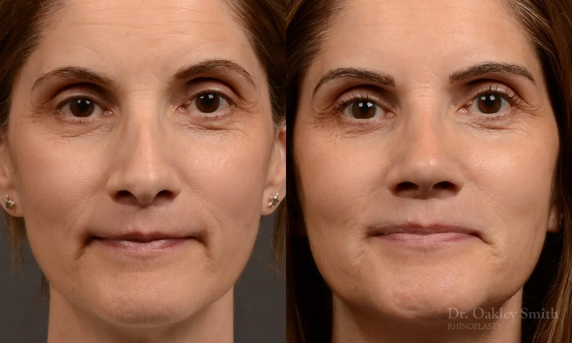 546: Female, Revision Rhinoplasty, Thin Skin, Inverted V, Residual Hump