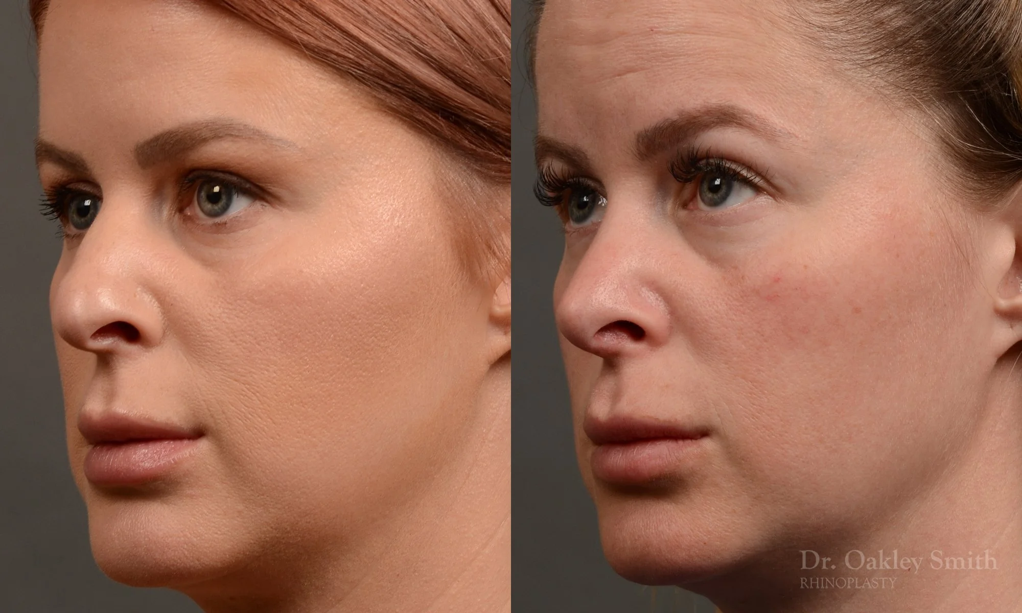 361D-rhinoplasty-dr-oakley-smith-toronto-nose-job.jpg