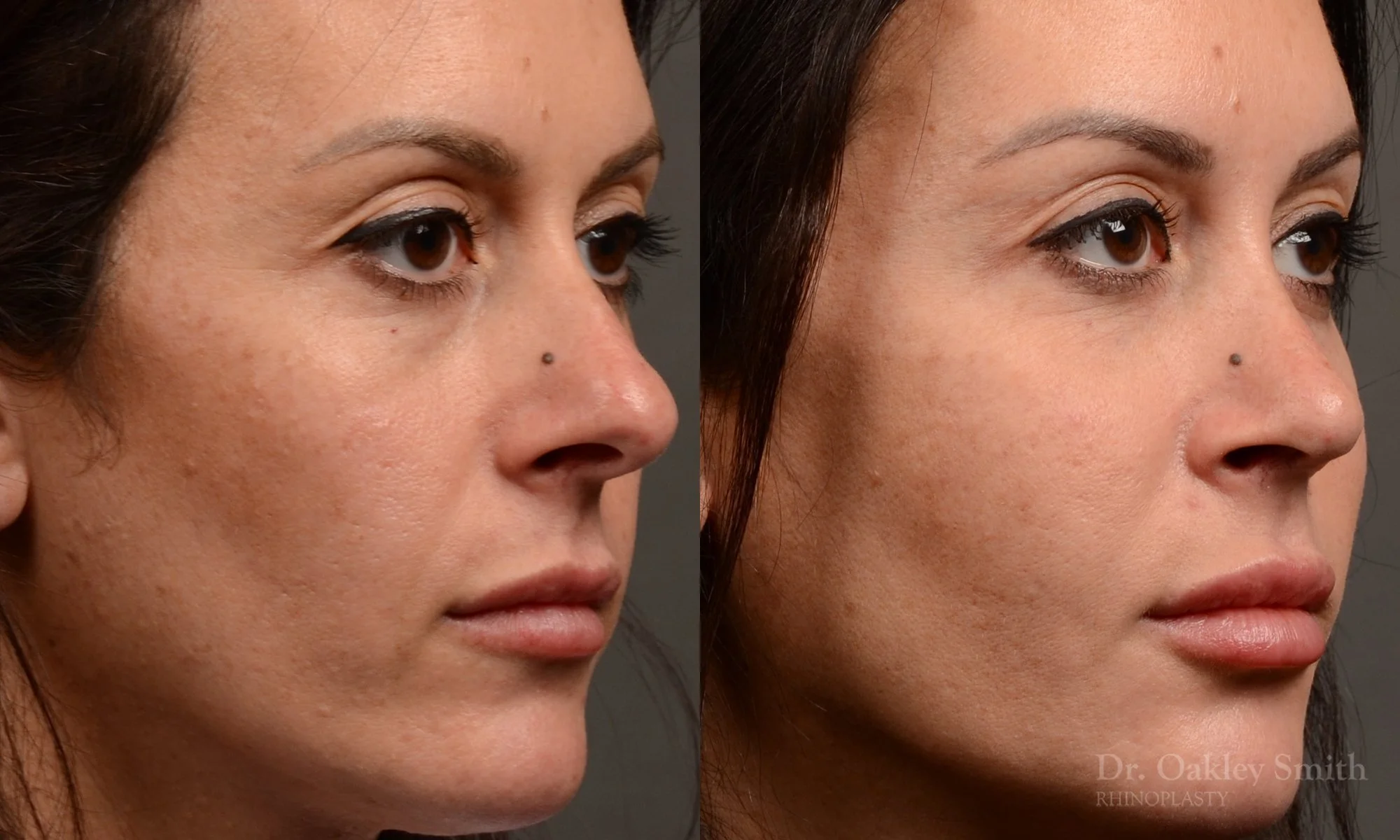 495B-rhinoplasty-dr-oakley-smith-toronto-top-surgeon-nose-job.jpg