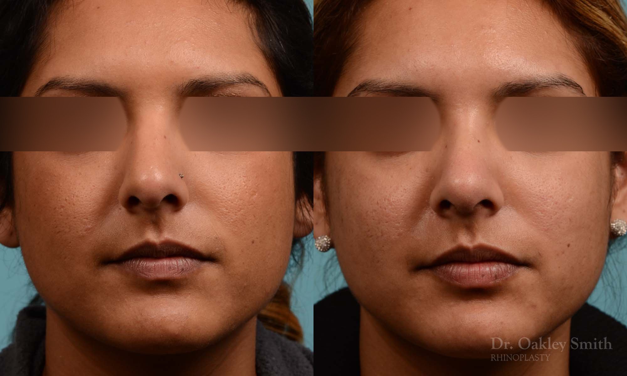 271A-rhinoplasty-dr-oakley-smith-toronto-nose-job.jpg