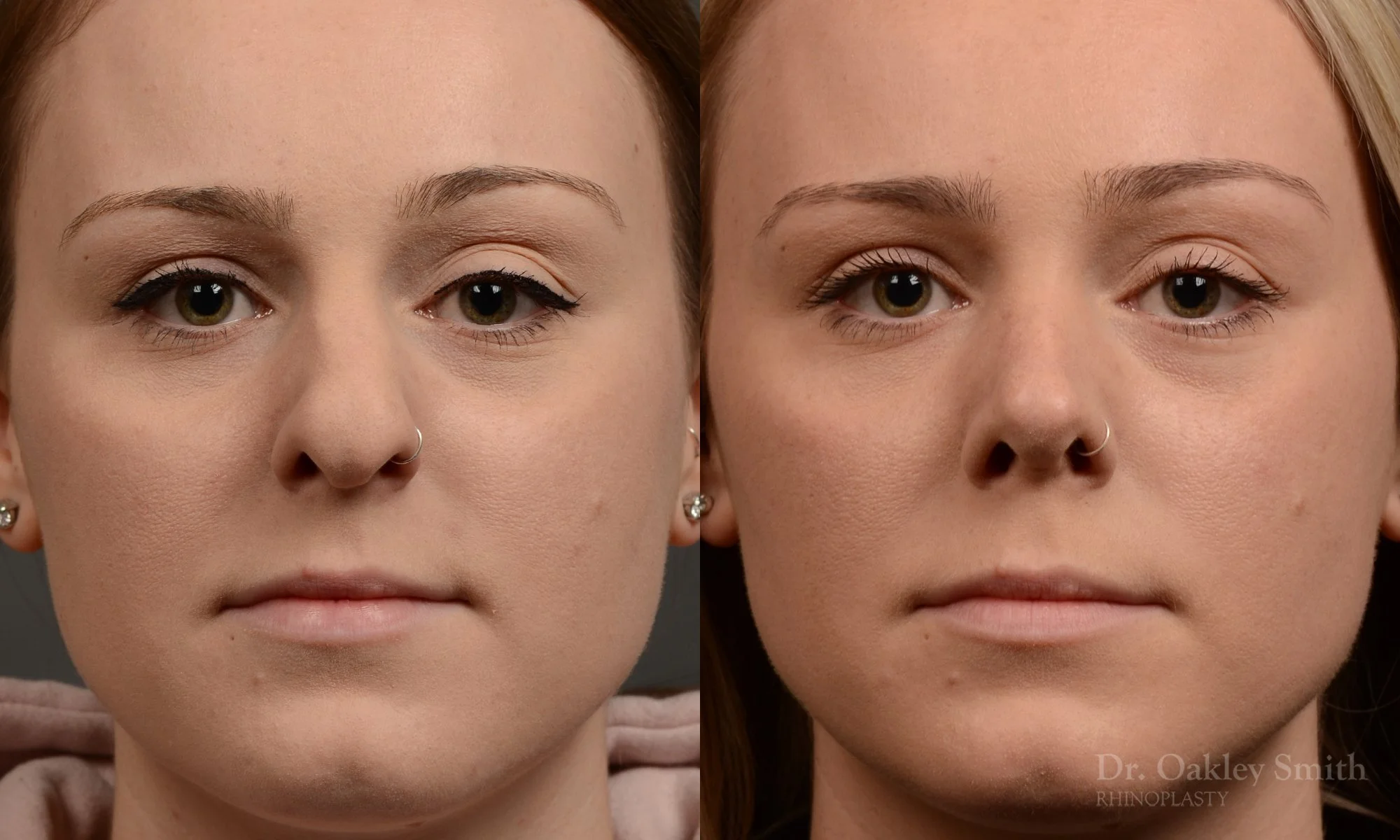 477A-rhinoplasty-dr-oakley-smith-toronto-top-surgeon-nose-job.jpg
