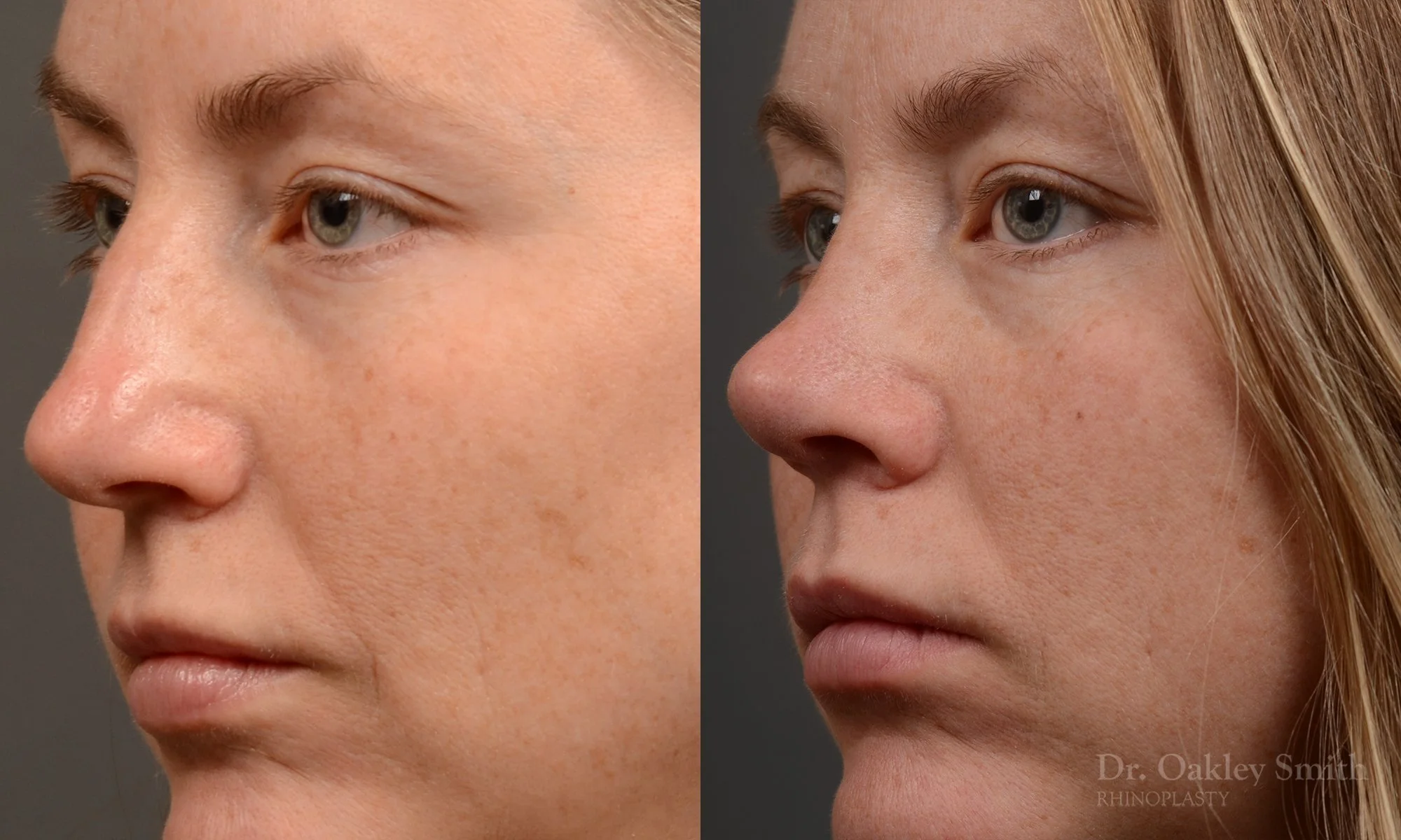 482D-rhinoplasty-dr-oakley-smith-toronto-top-surgeon-nose-job-1.jpg