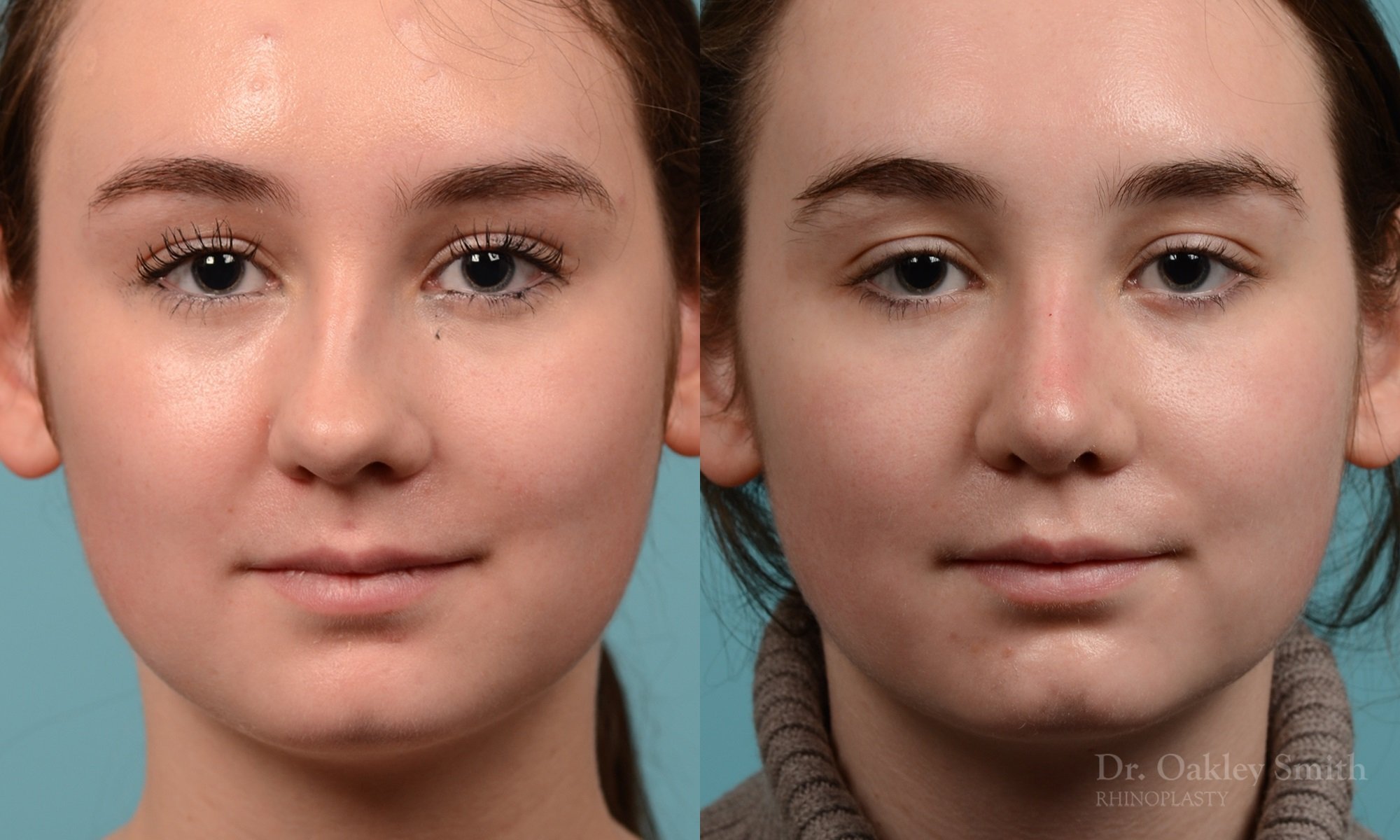 264A-rhinoplasty-dr-oakley-smith-toronto-nose-job.jpg