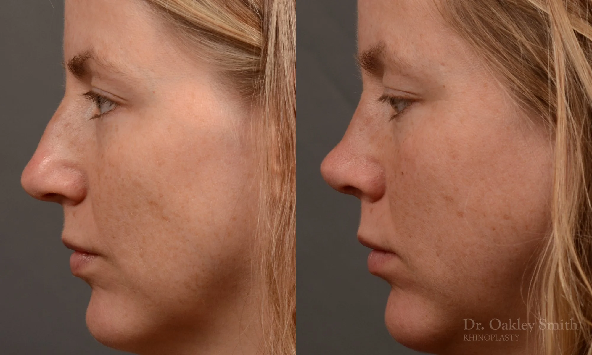 482E-rhinoplasty-dr-oakley-smith-toronto-top-surgeon-nose-job-1.jpg