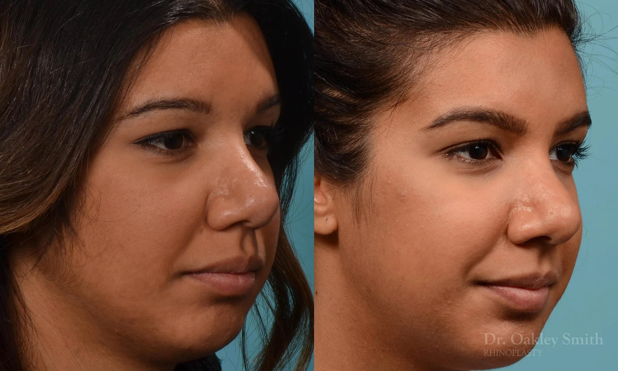 237B-rhinoplasty-dr-oakley-smith-1-1.jpg