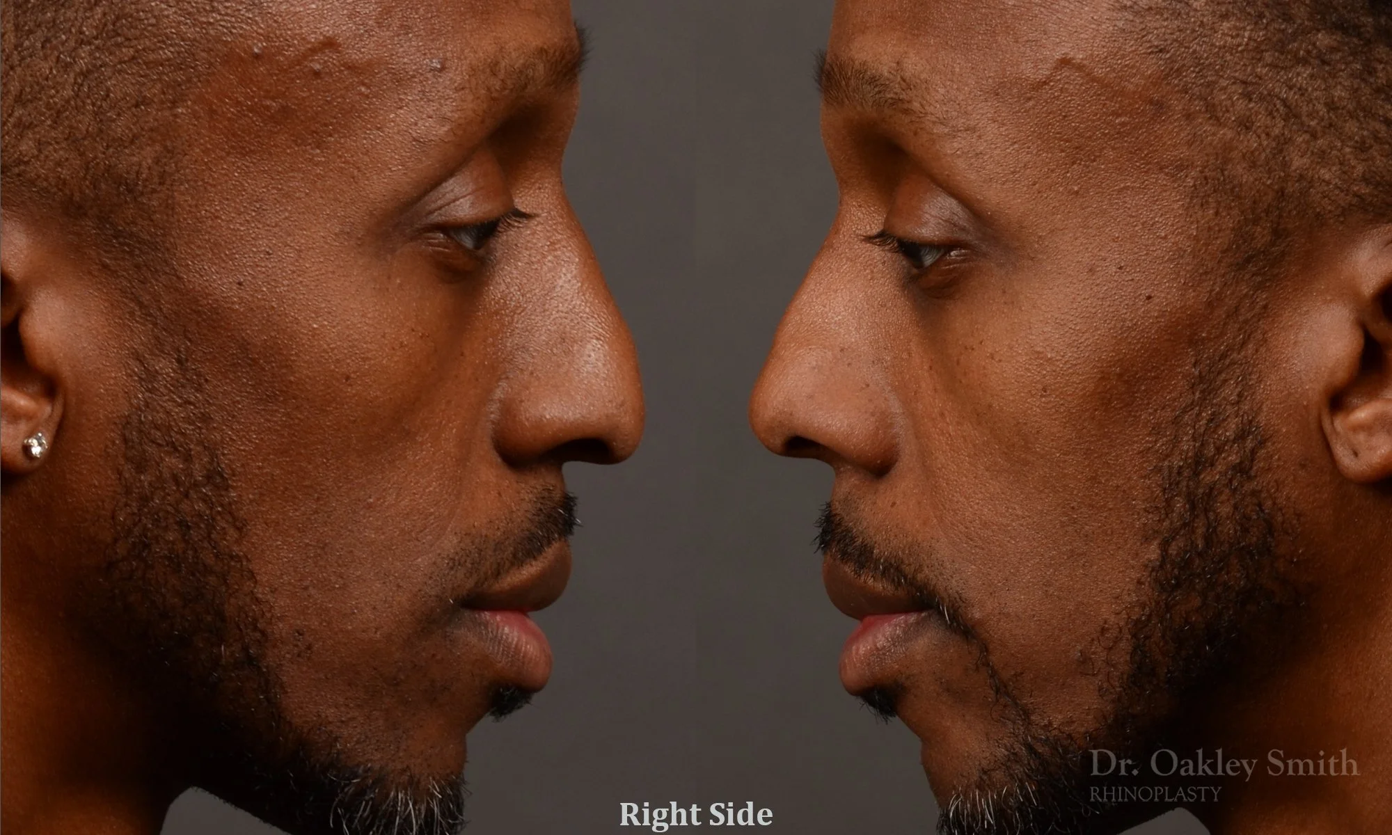 504: Primary Male Rhinoplasty, Normal Skin, Wide Bridge, Tip Work, Ethnic Rhinoplasty