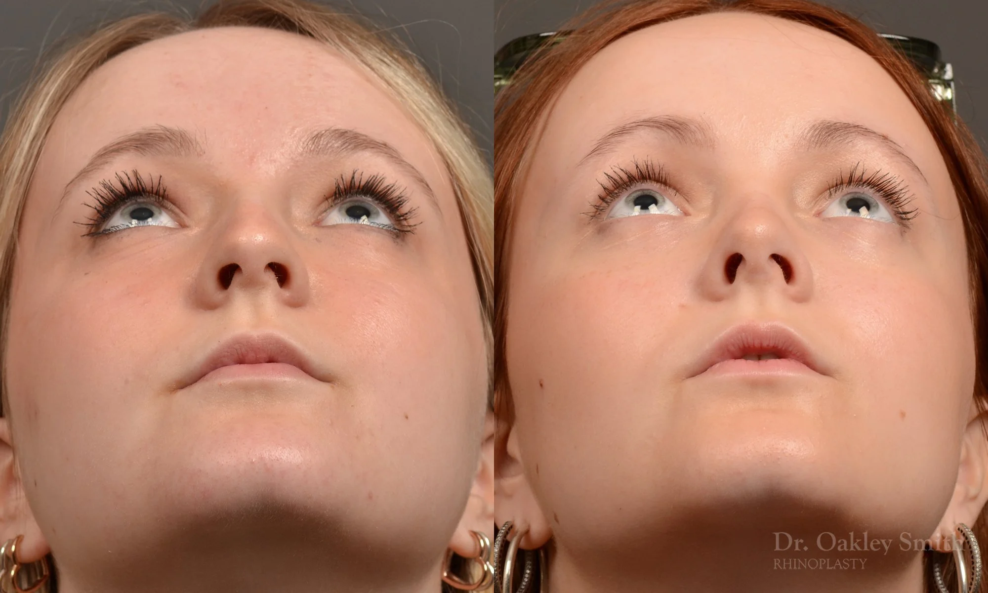 475F-rhinoplasty-dr-oakley-smith-toronto-top-surgeon-nose-job.jpg