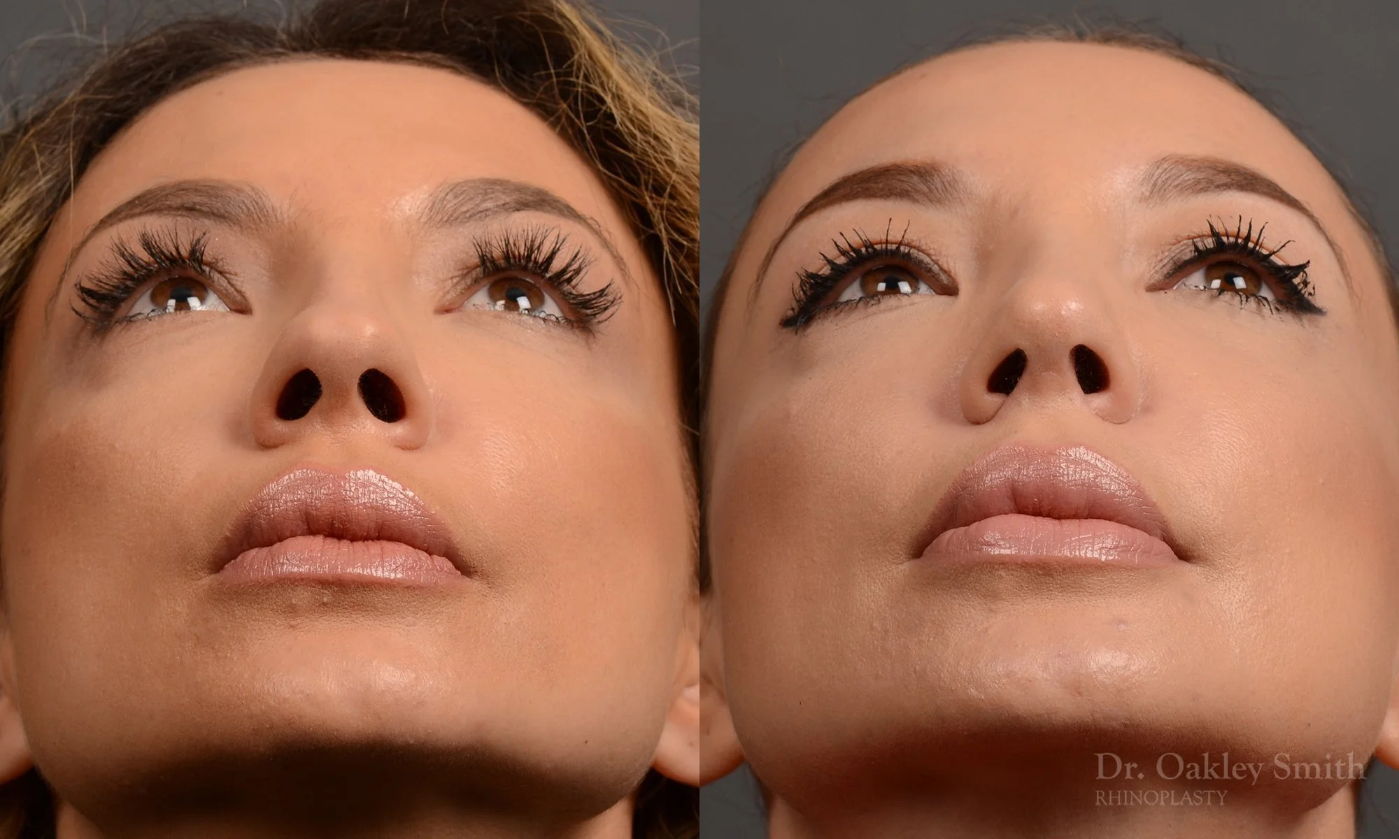 354F-rhinoplasty-dr-oakley-smith-toronto-nose-job.jpg