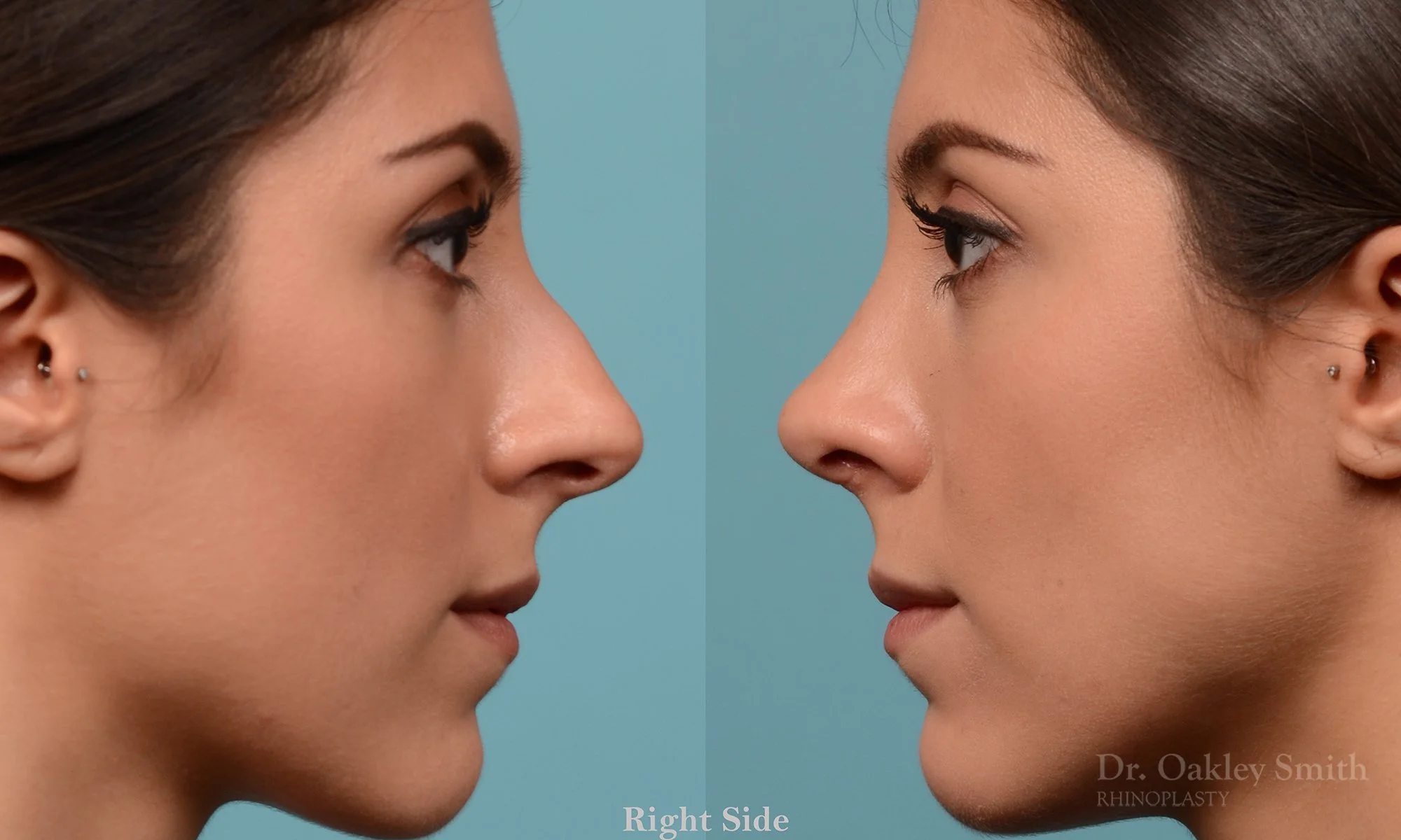 229C-rhinoplasty-oakley-smith-toronto-nose-job-straight-nose-bridge-1.jpg