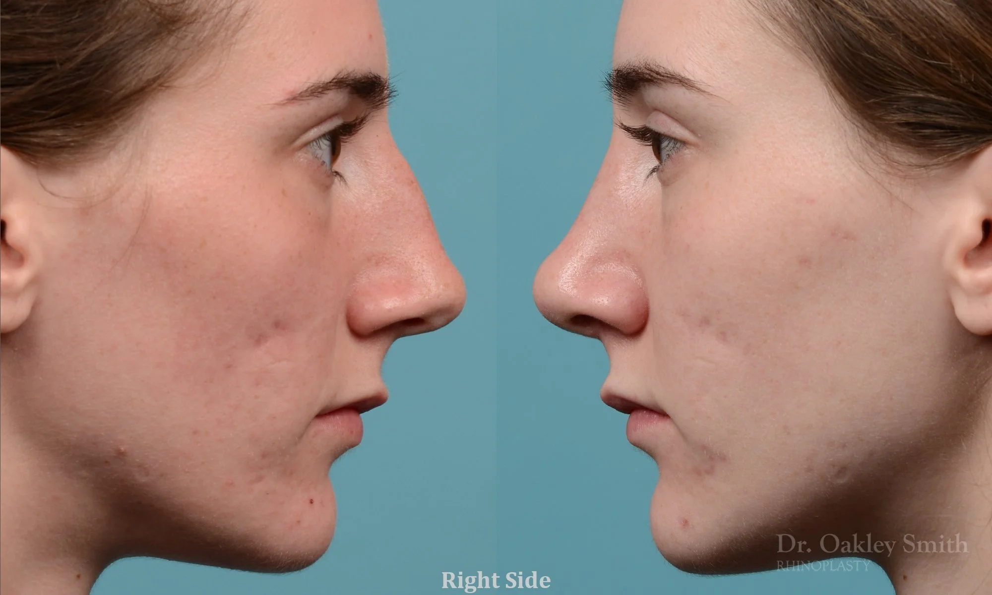 248: Female, Primary Rhinoplasty, Thin Skin, Dorsal Bump Ridge