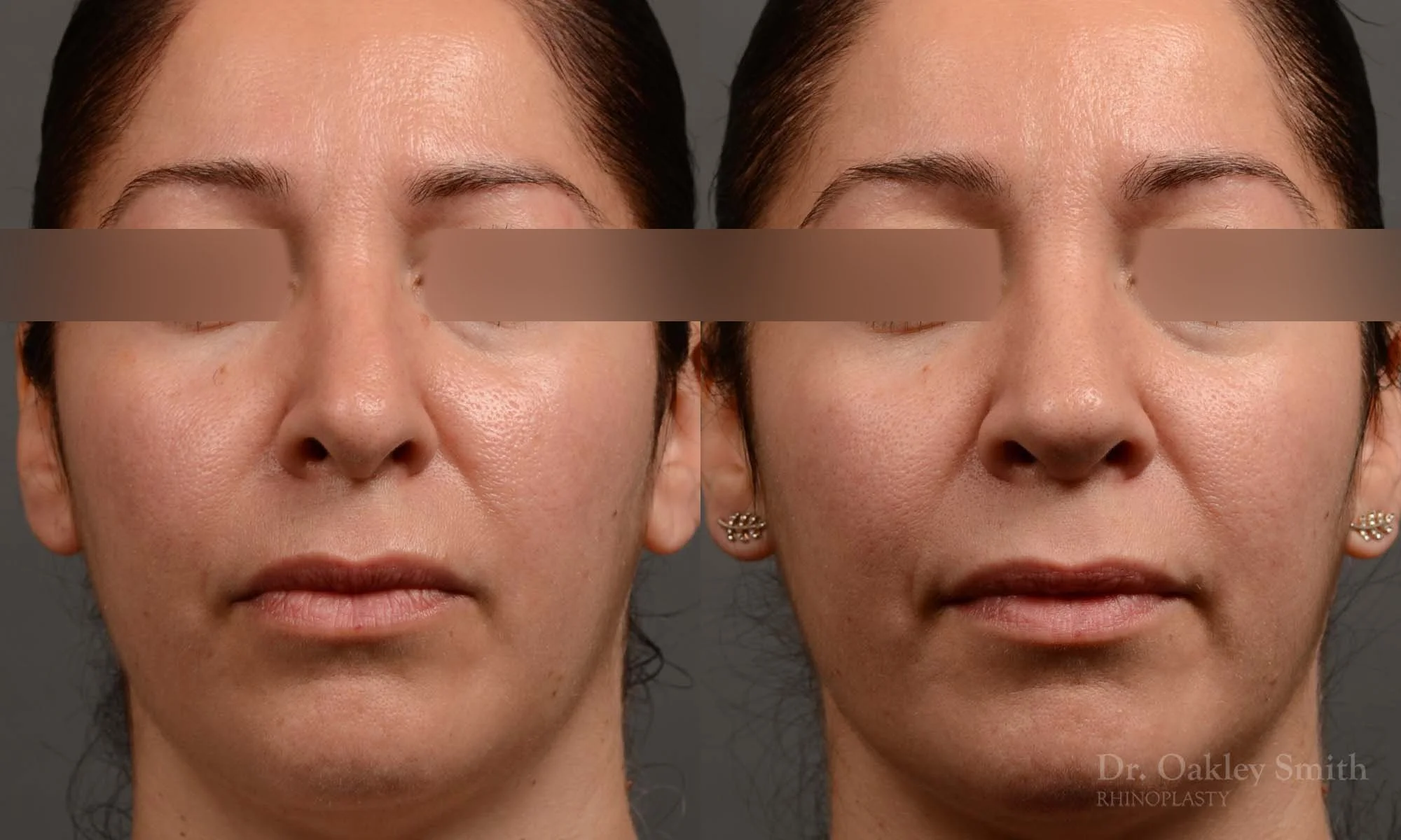 331A-rhinoplasty-dr-oakley-smith-toronto-nose-job.jpg