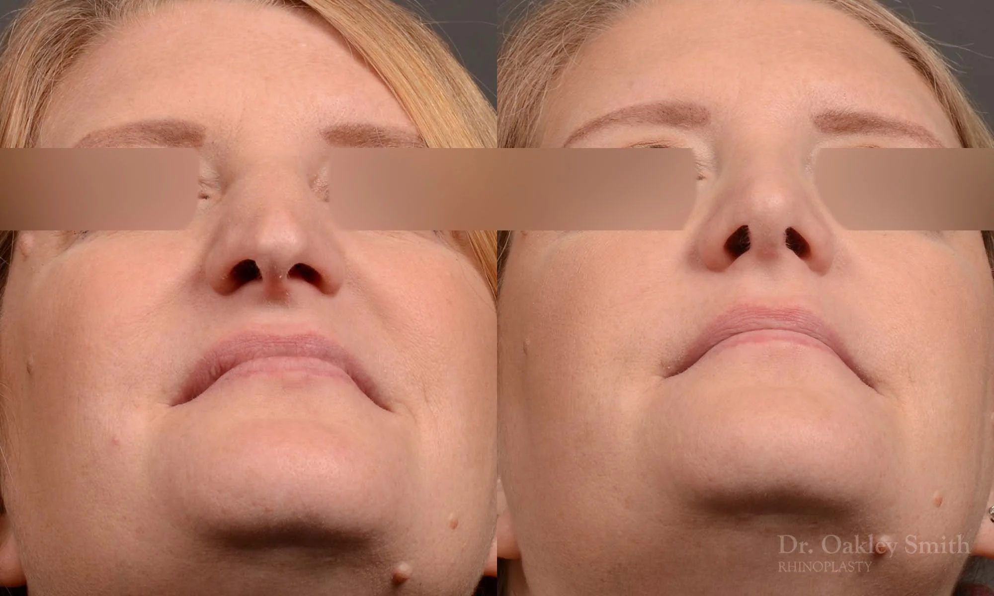 489F-rhinoplasty-dr-oakley-smith-toronto-top-surgeon-nose-job.jpg
