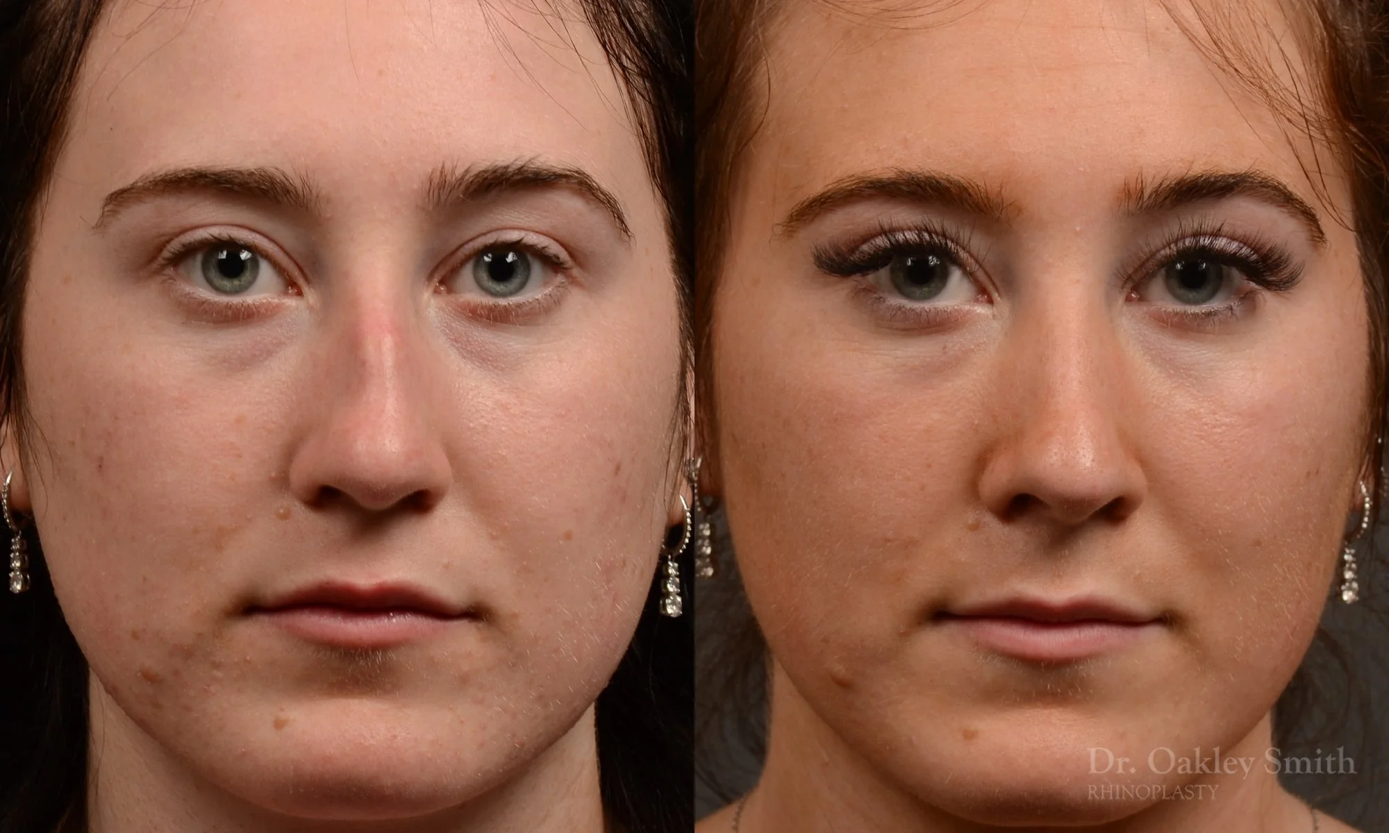484A-rhinoplasty-dr-oakley-smith-toronto-top-surgeon-nose-job.jpg