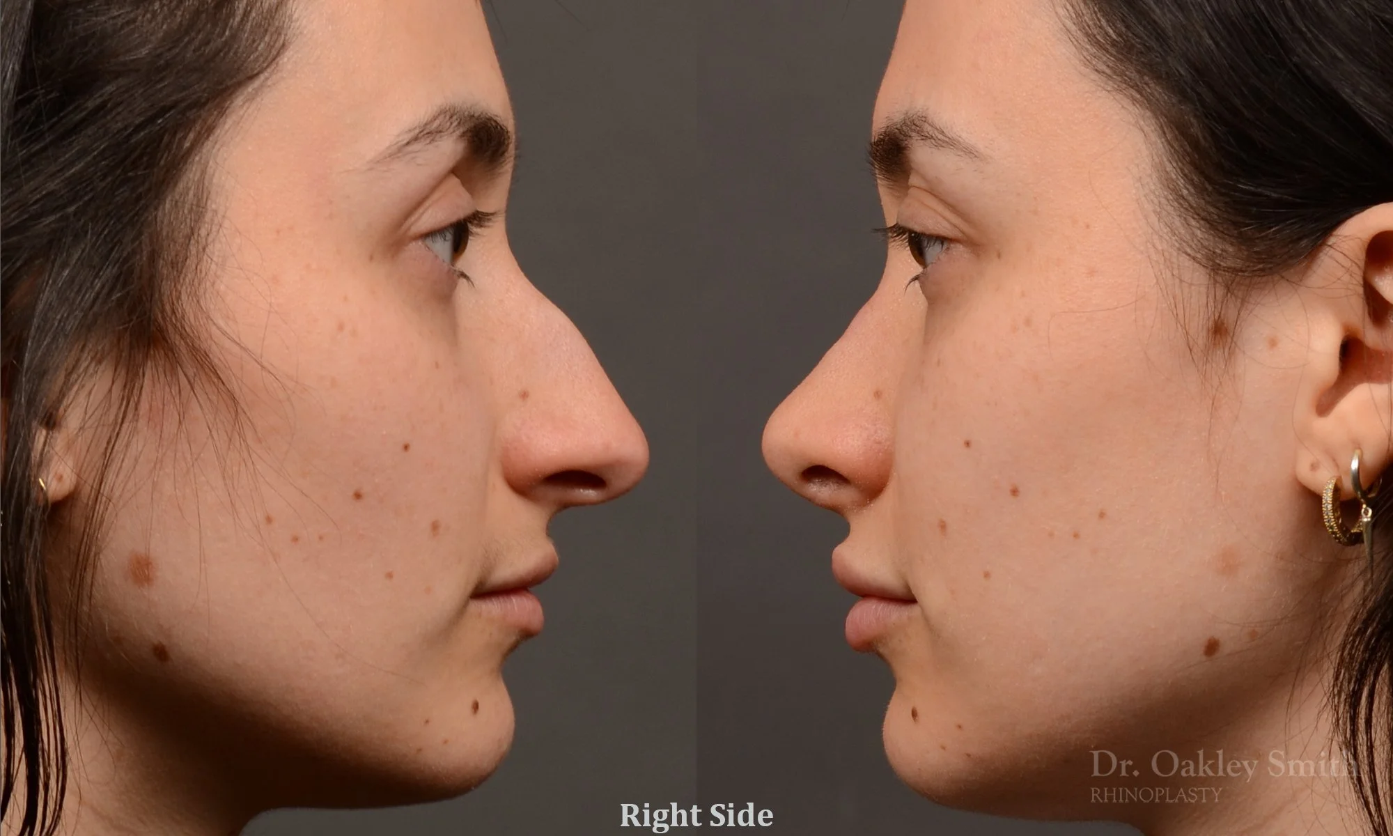 506: Female, Ethnic Rhinoplasty, Dorsal Bump, Tip Refinement, Crooked
