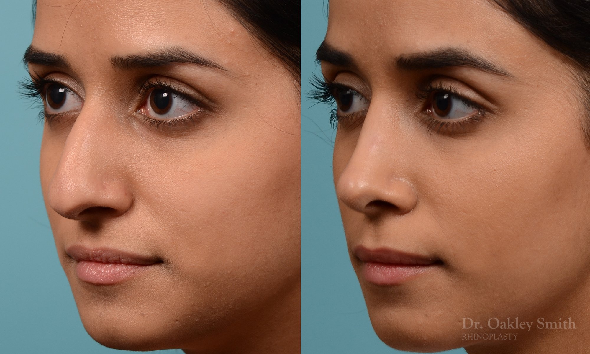 228D-nose-job-rhinoplasty-dr-oakley-smith-toronto-bump-on-the-nose-bridge-bump-4.jpg