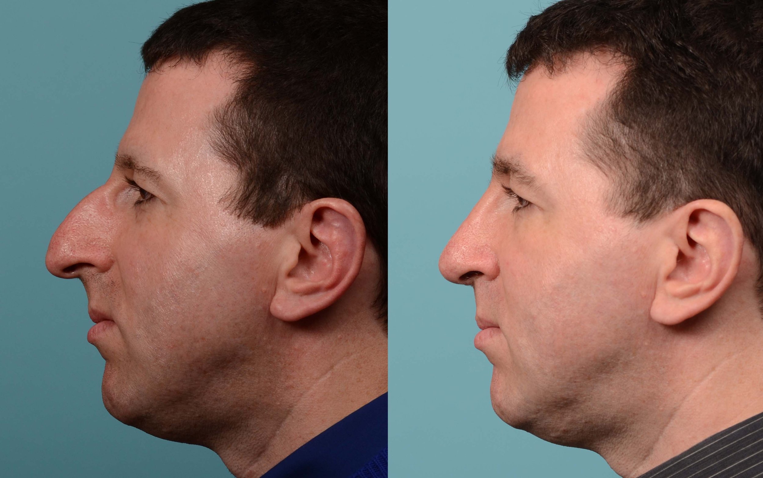 large-curved-male-nose-left-profile-view-before-after-1.jpg