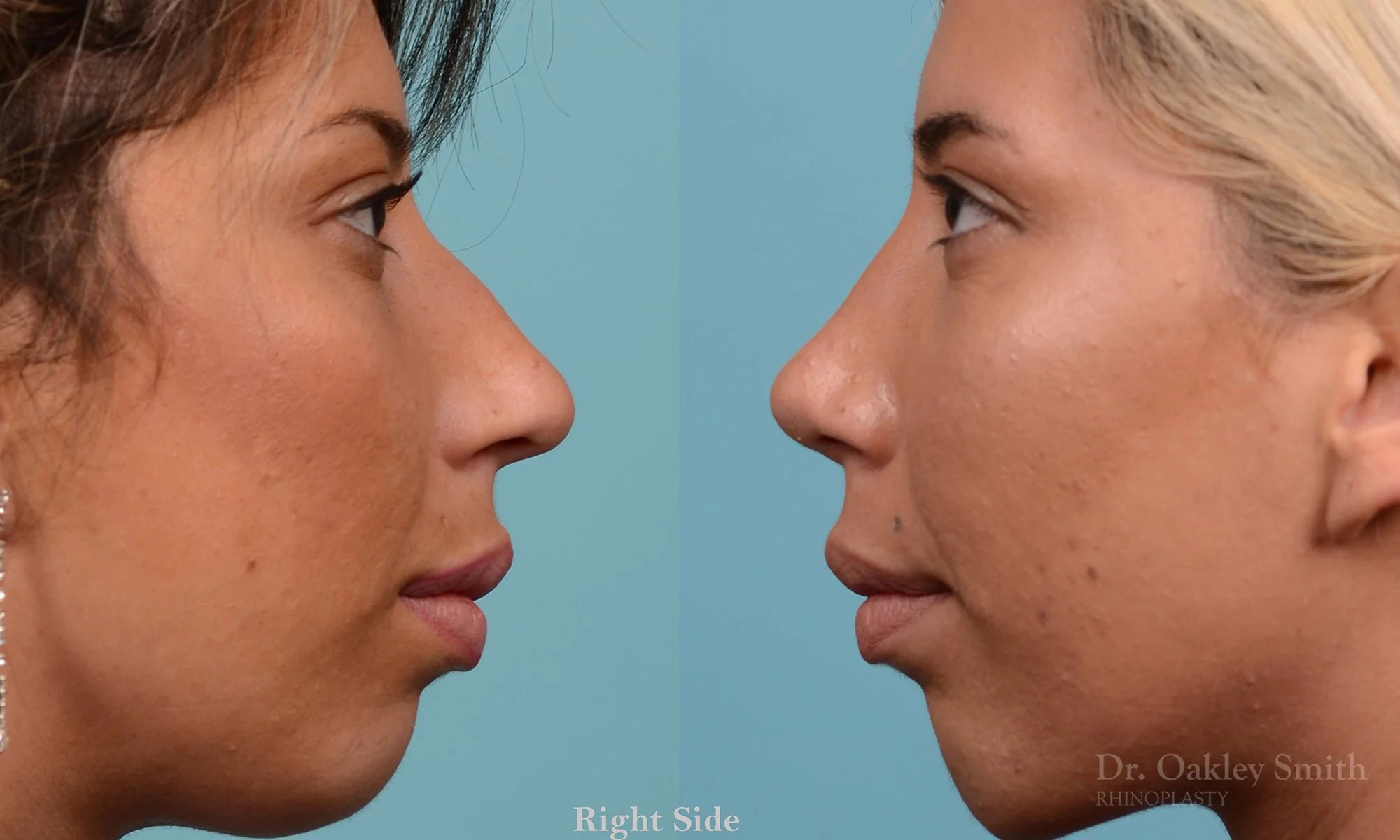 200: Female, Ethnic Rhinoplasty, Dorsal Hump, Tip Narrowing