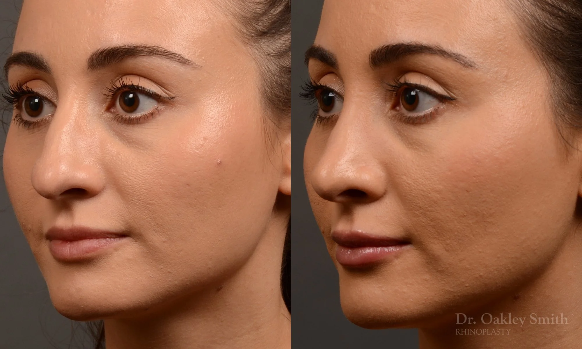 522D-rhinoplasty-dr-oakley-smith-toronto-top-surgeon-nose-job.jpg