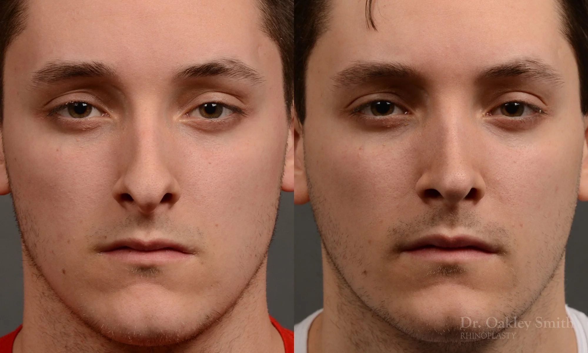 377.1A-rhinoplasty-dr-oakley-smith-toronto-nose-job.jpg